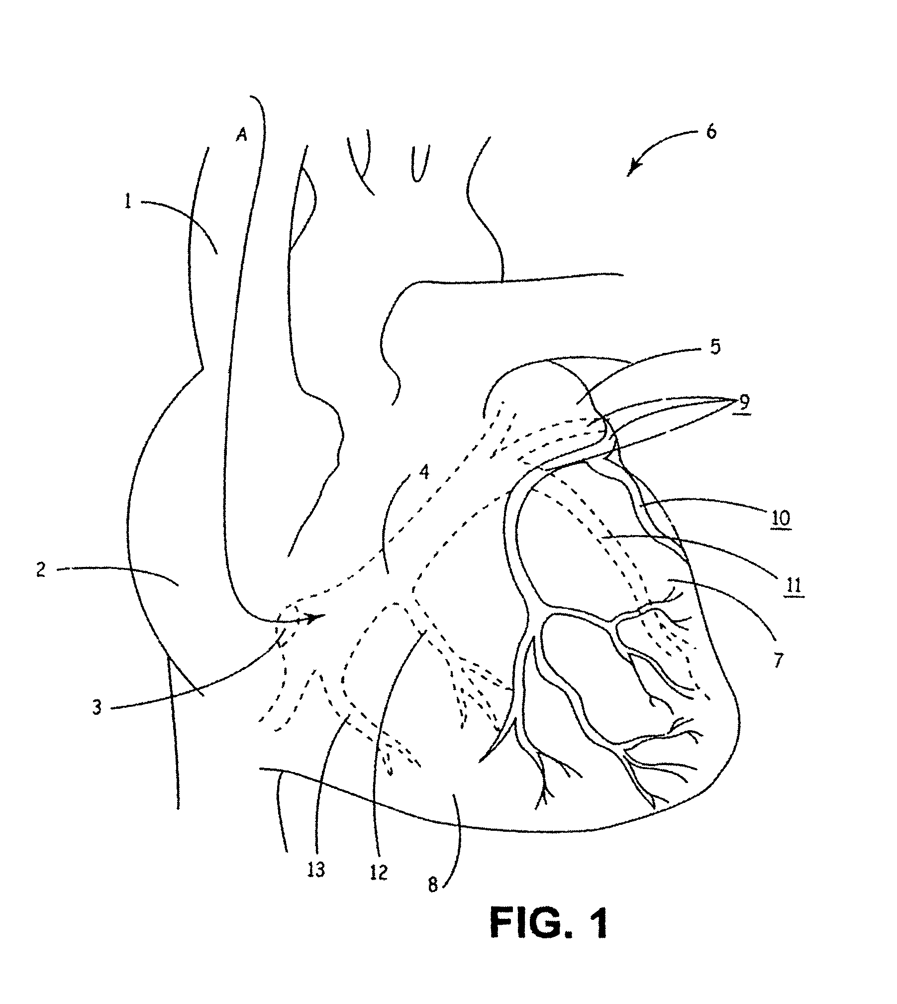 Guide catheters for accessing cardiac sites