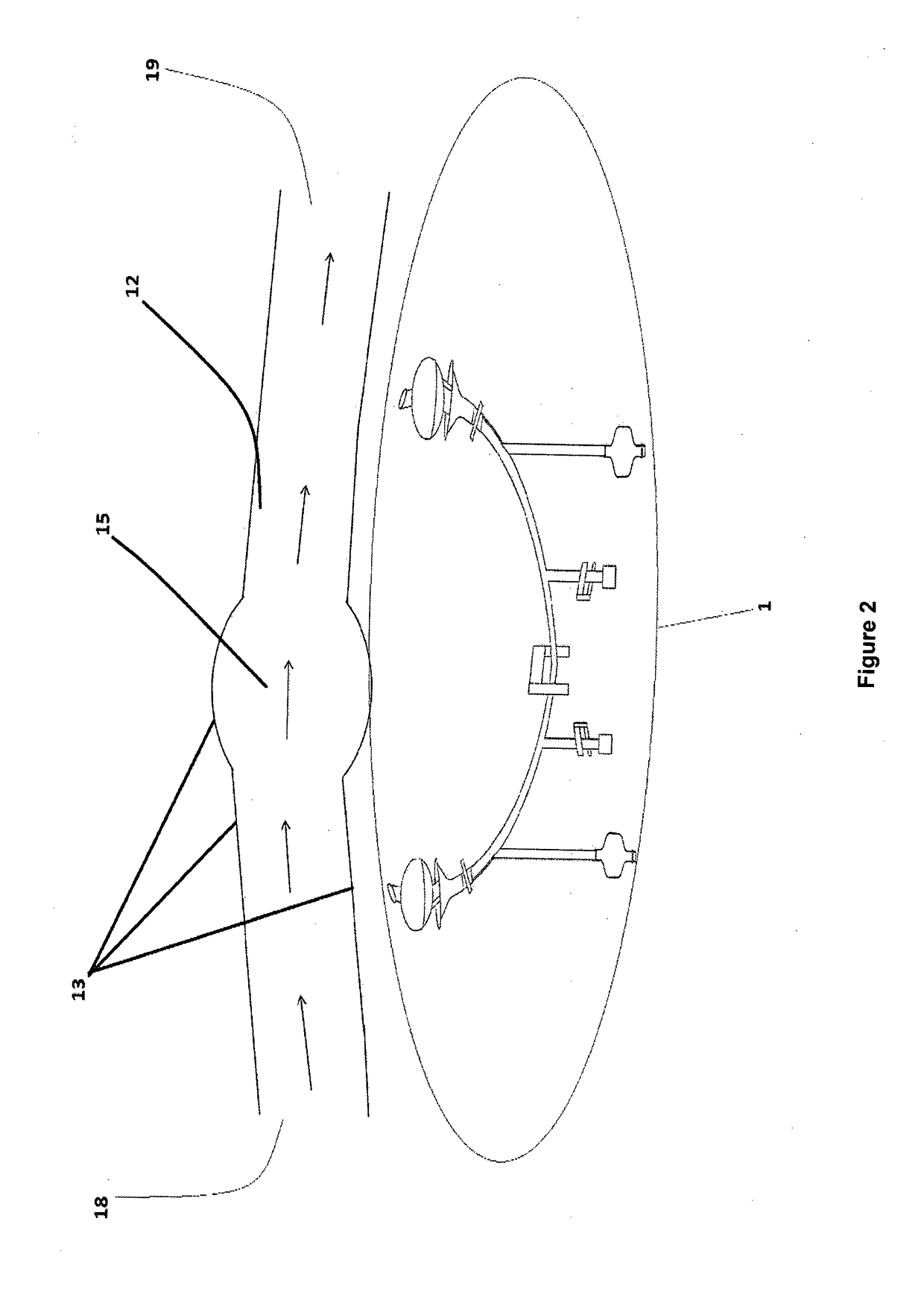 Catheter maintaining blood flow by vein bypass