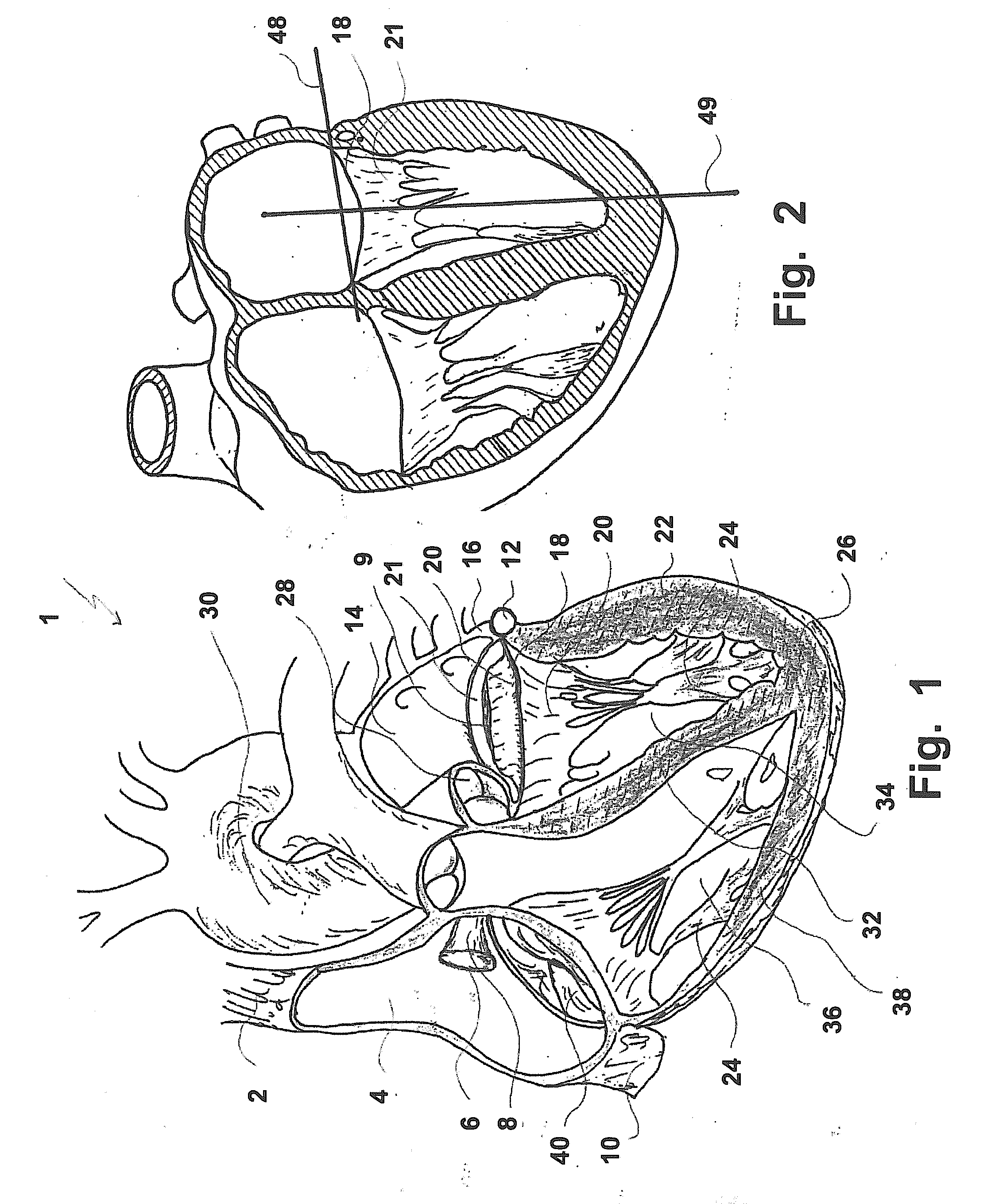 Device And A Method For Augmenting Heart Function