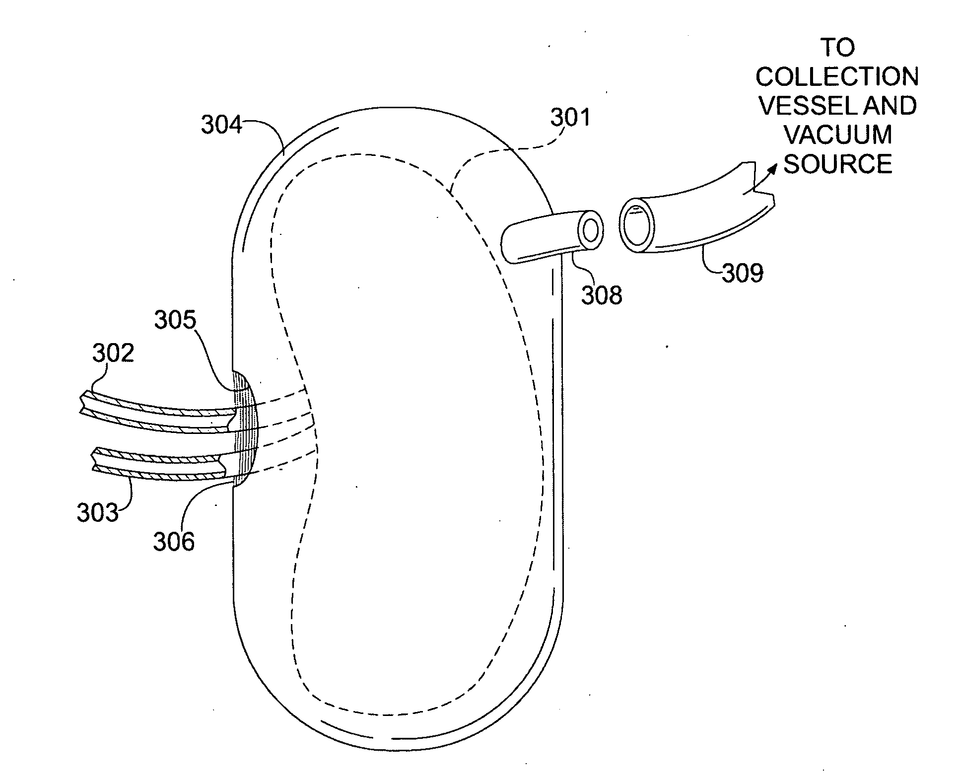 Apparatus and Method for Cardiac Tissue Modulation by Topical Application of Vacuum to Minimize Cell Death and Damage