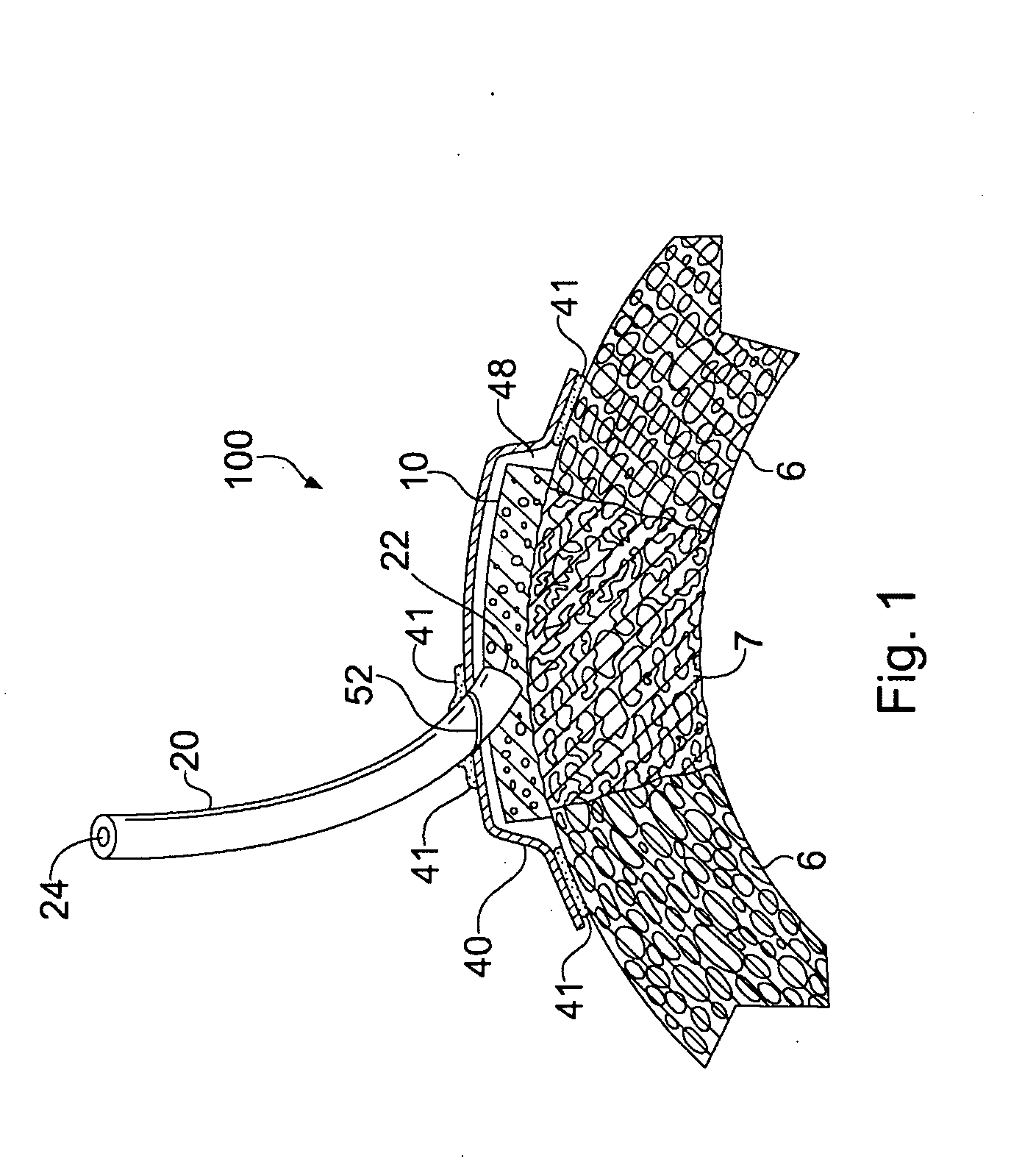 Apparatus and Method for Cardiac Tissue Modulation by Topical Application of Vacuum to Minimize Cell Death and Damage