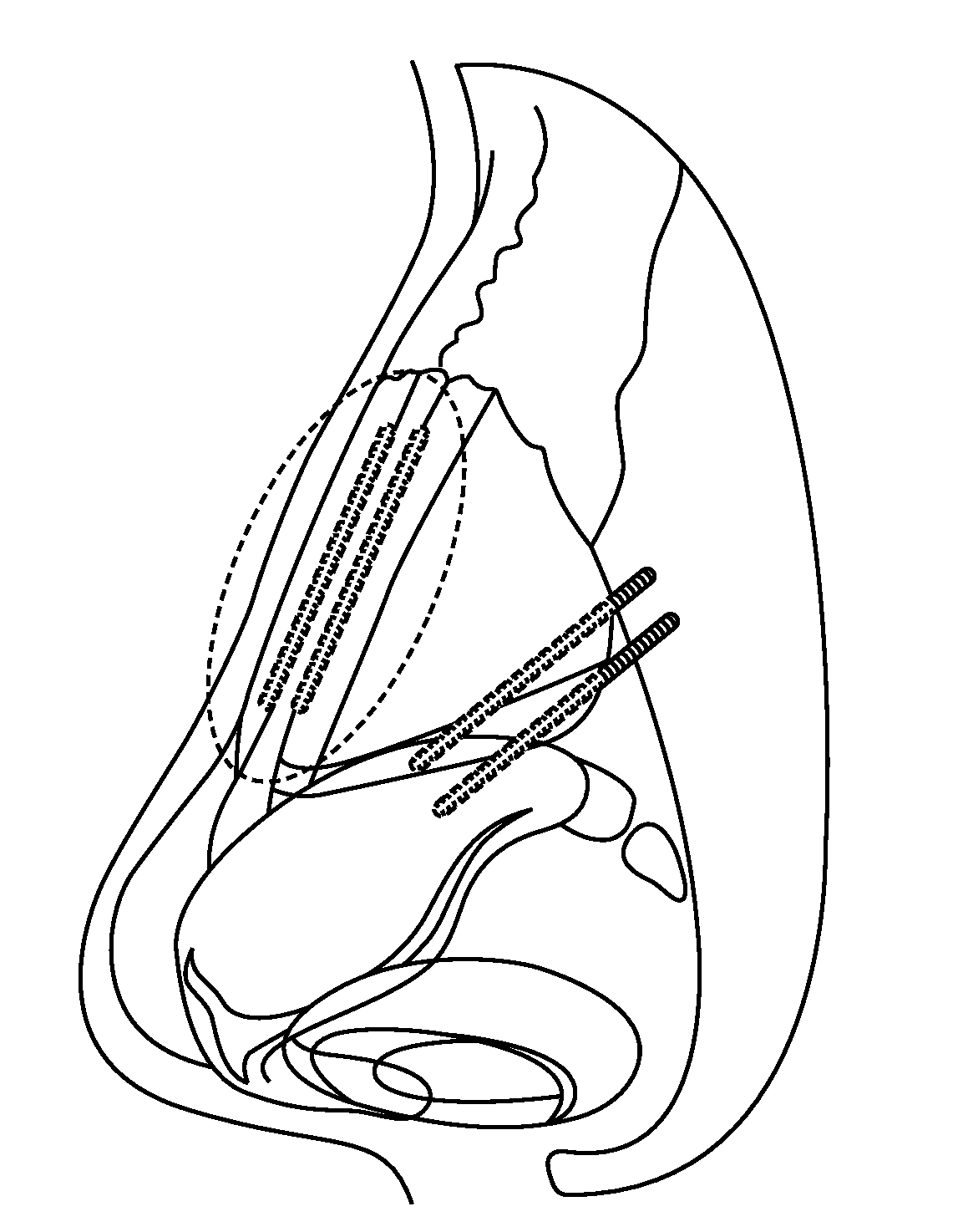 Nasal implants and systems and methods of use