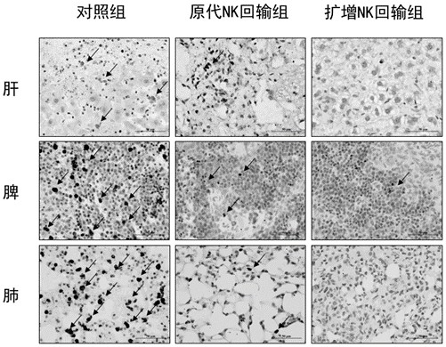 Application of NK (Natural Killer) cells, NK cell reinfusion preparation and combined preparation