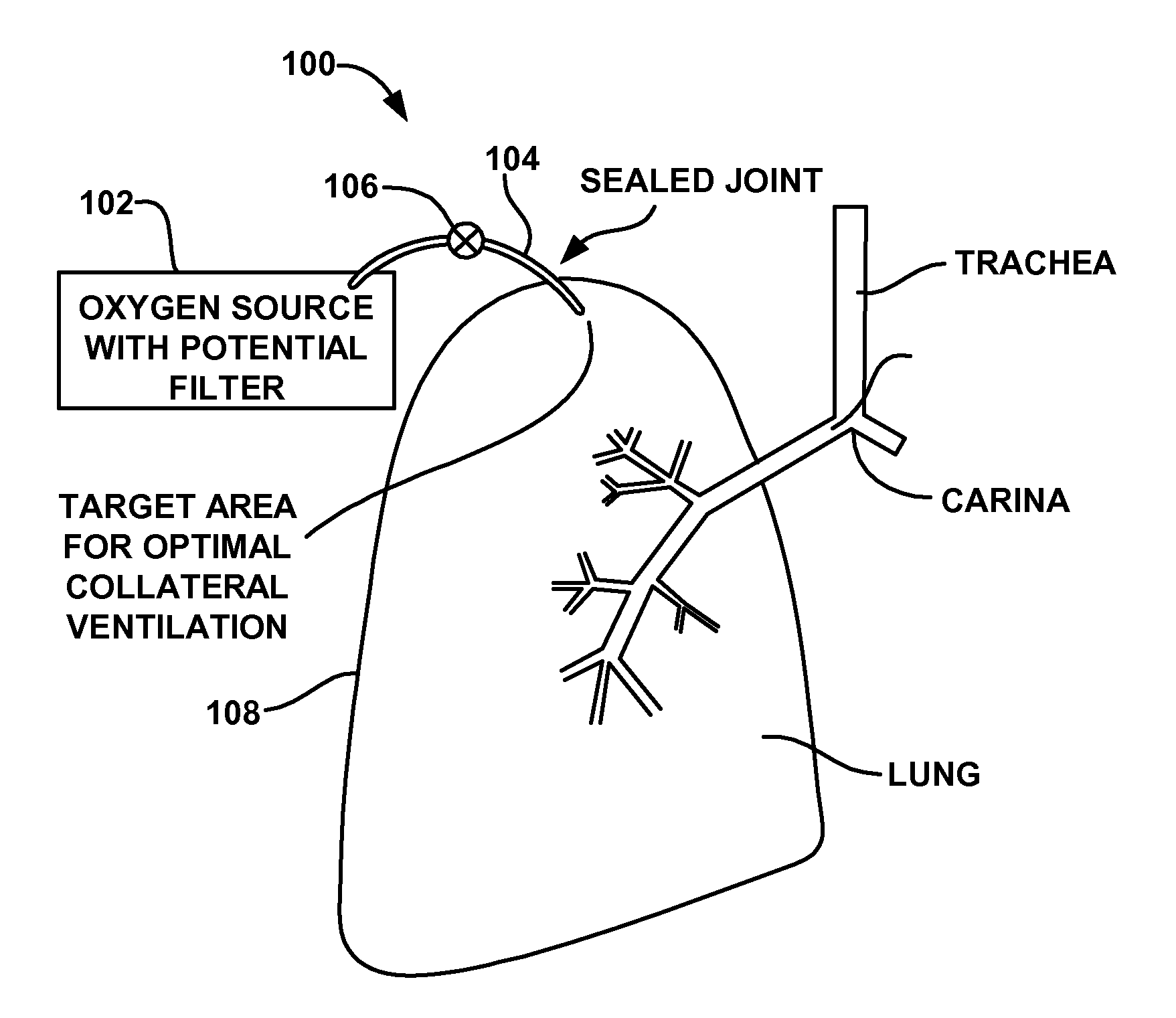 Collateral ventilation device with chest tube/evacuation features and method