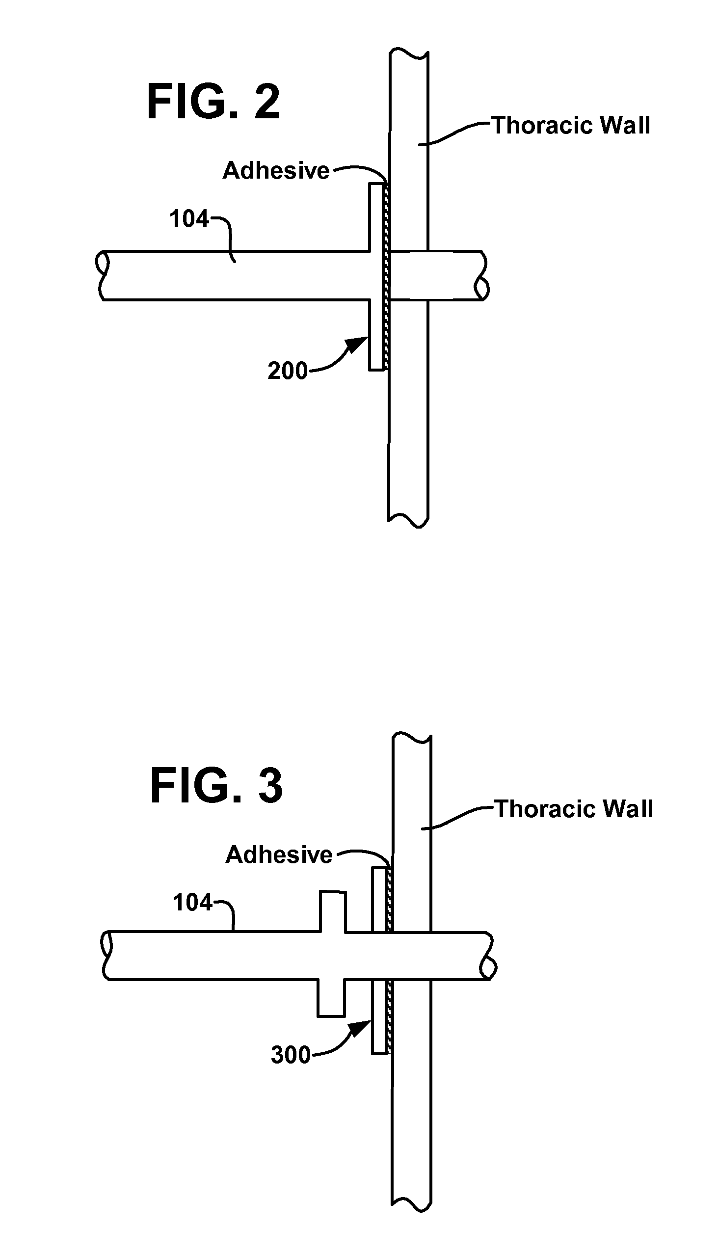 Collateral ventilation device with chest tube/evacuation features and method