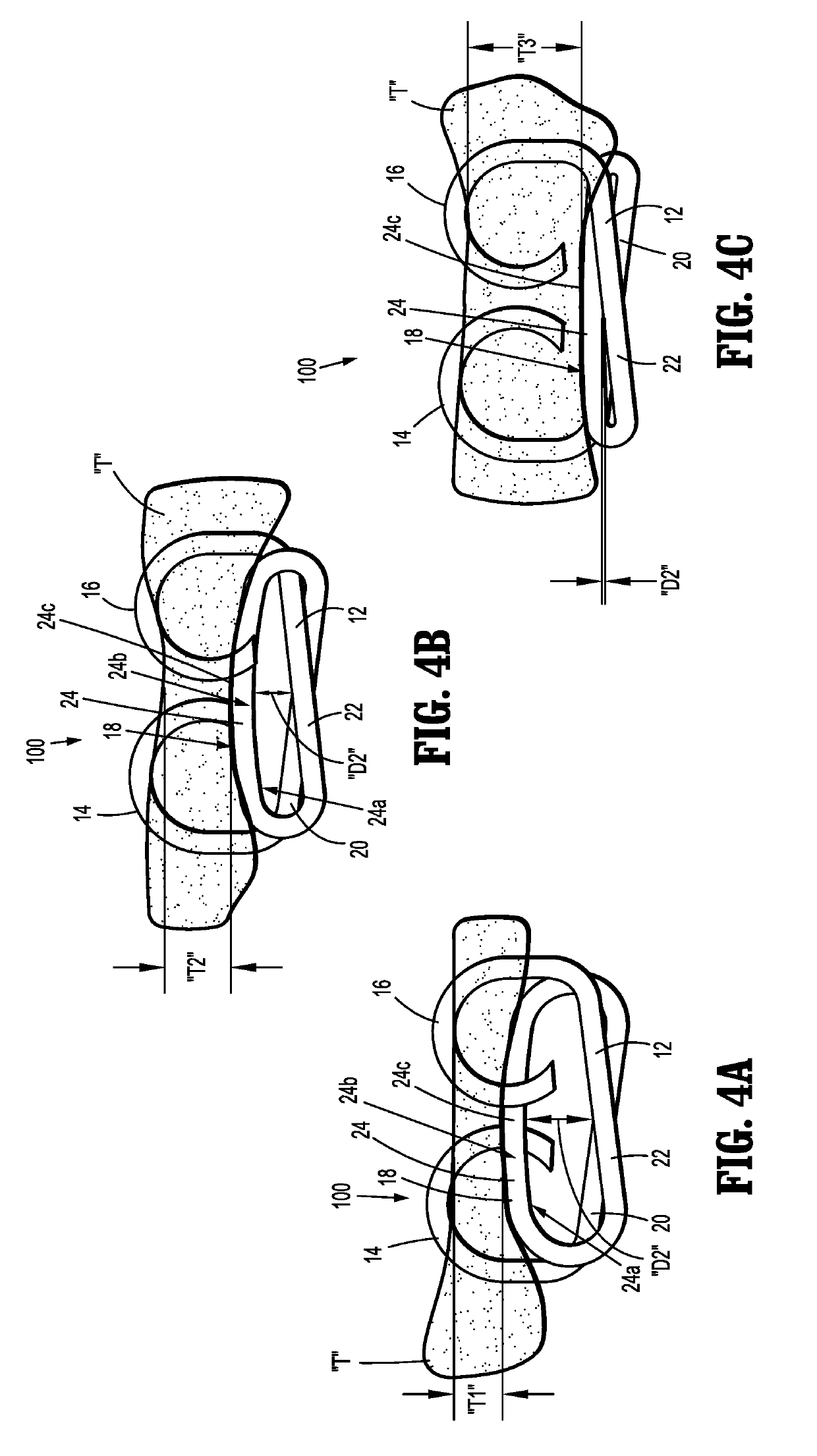 Surgical staples with expandable backspan