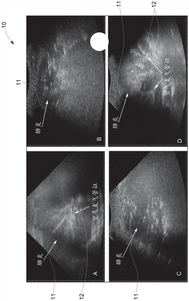 Guided lung coverage and automatic detection using ultrasound device