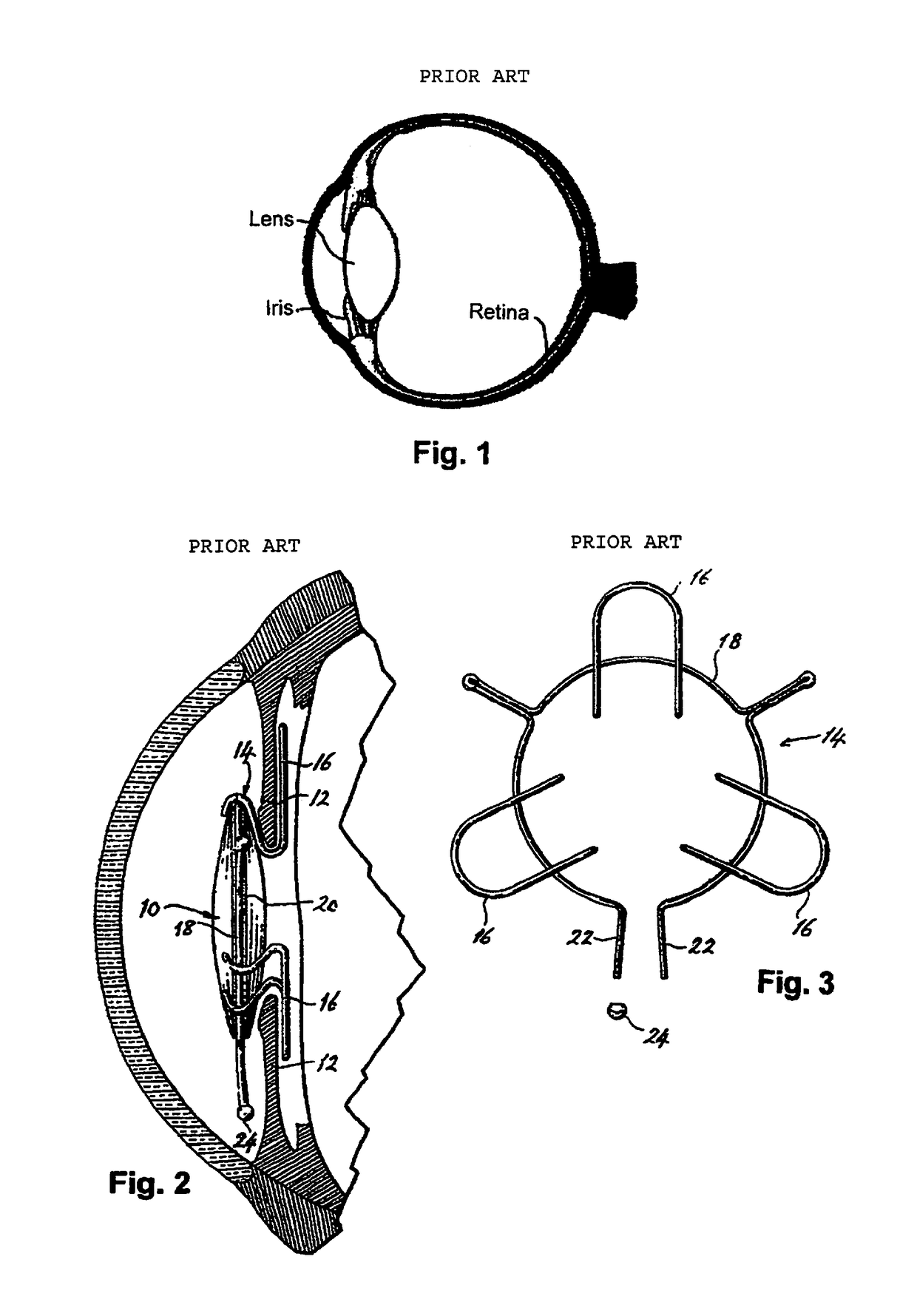 Intraocular implant and method for fixing same into an eye