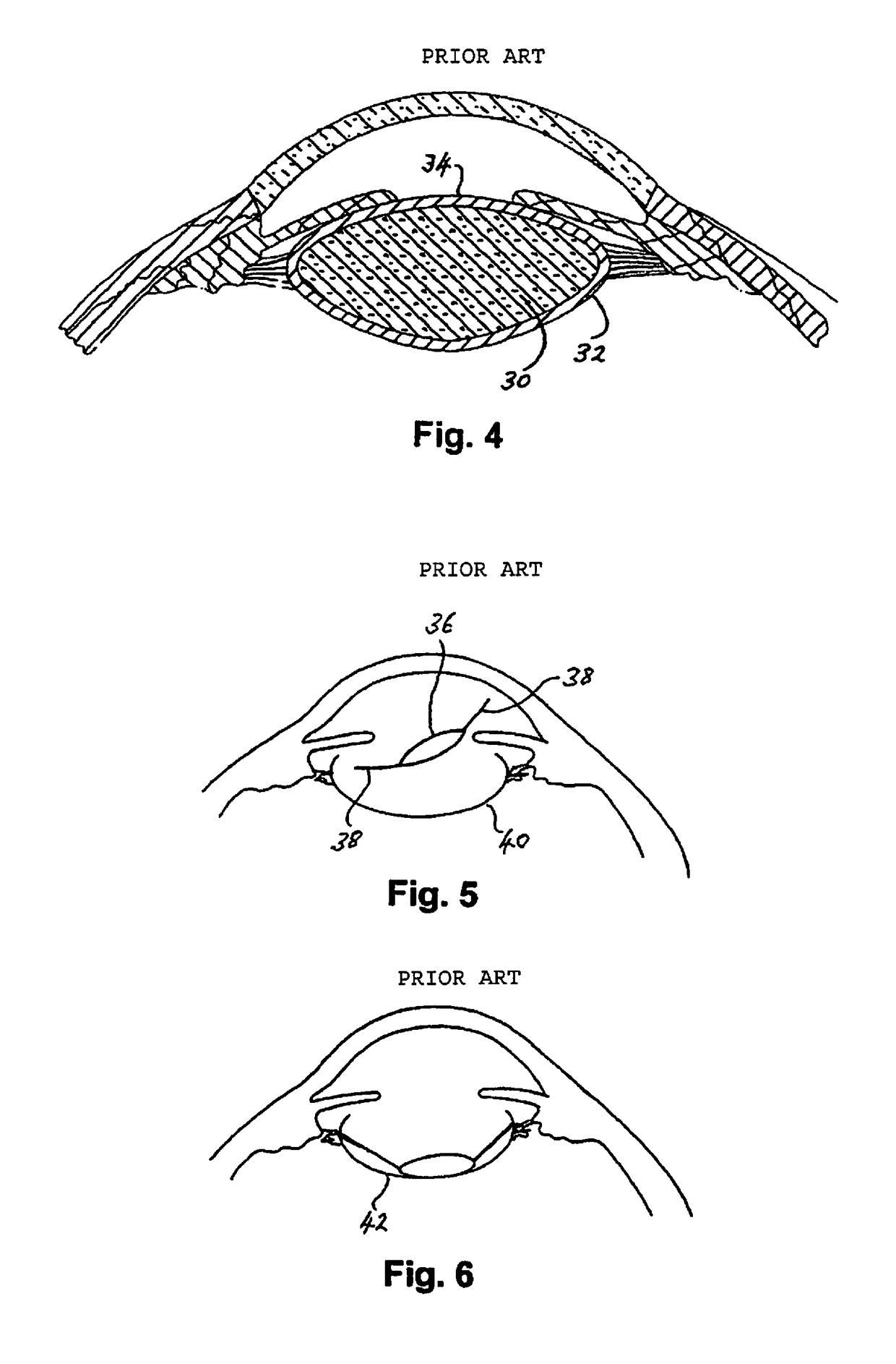 Intraocular implant and method for fixing same into an eye