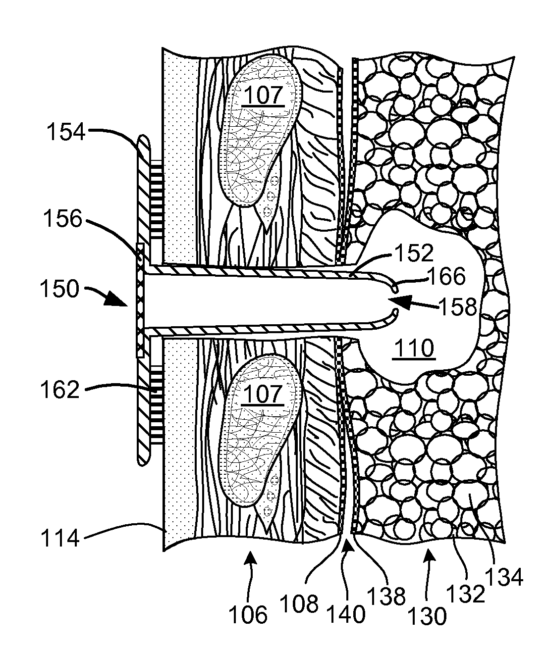 Pneumostoma management device with integrated patency sensor and method