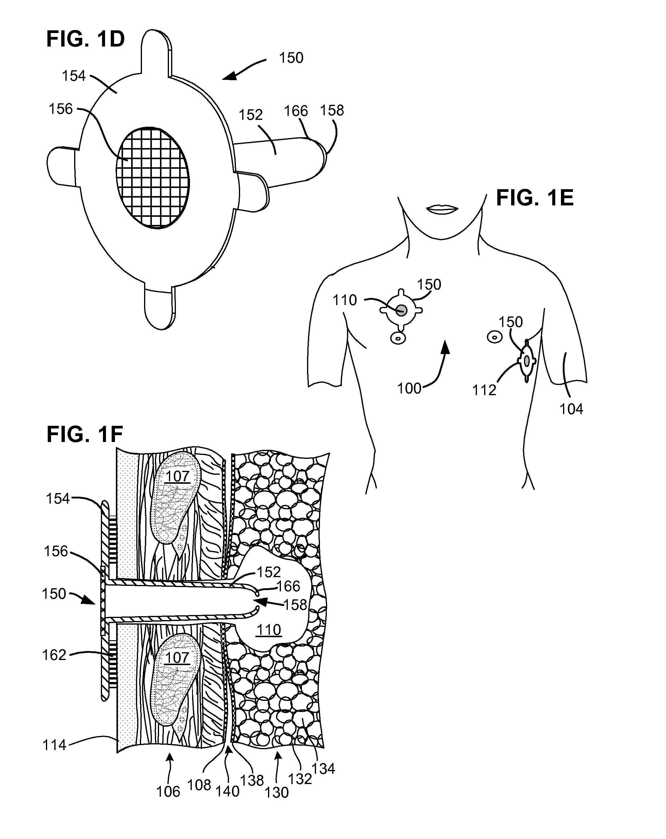 Pneumostoma management device with integrated patency sensor and method