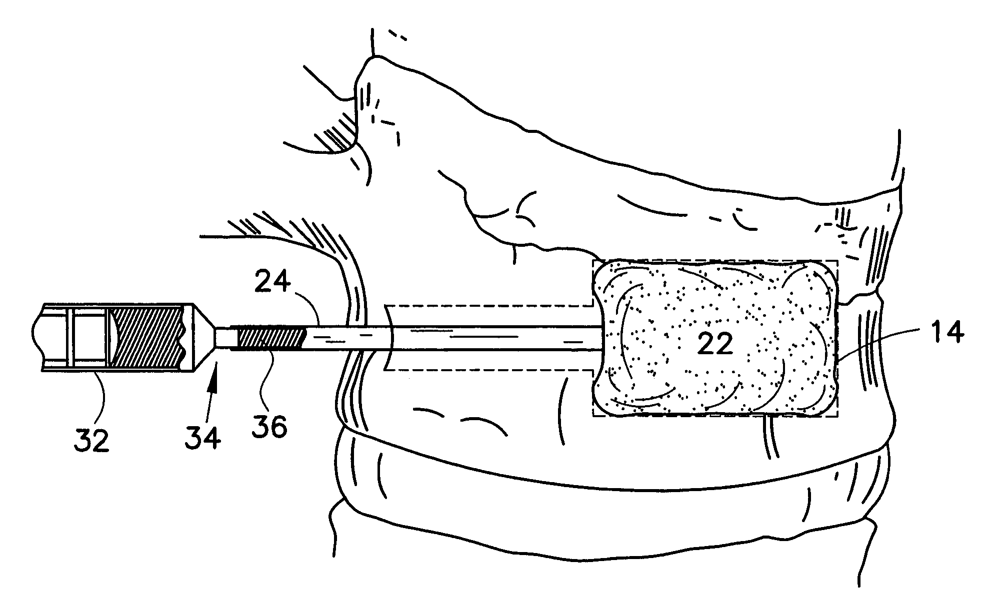 Method and apparatus for treating a vertebral body