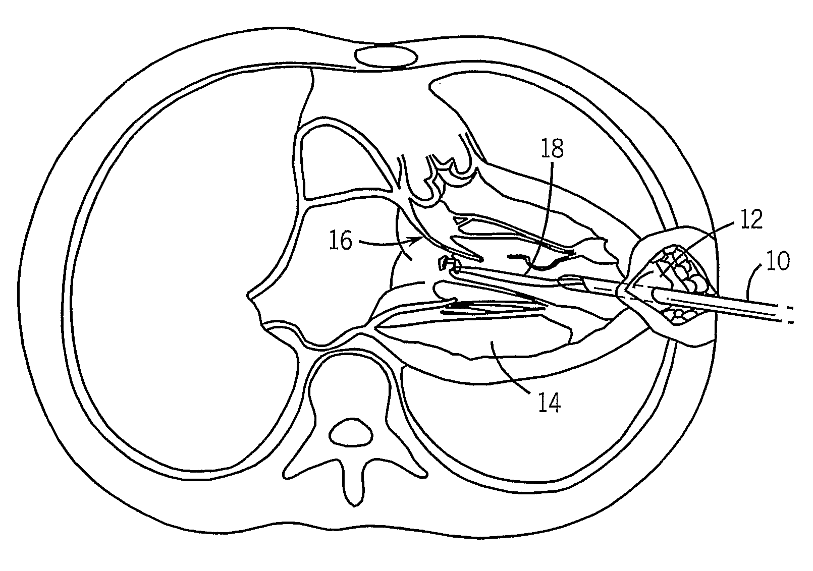 Thorascopic Heart Valve Repair Method and Apparatus