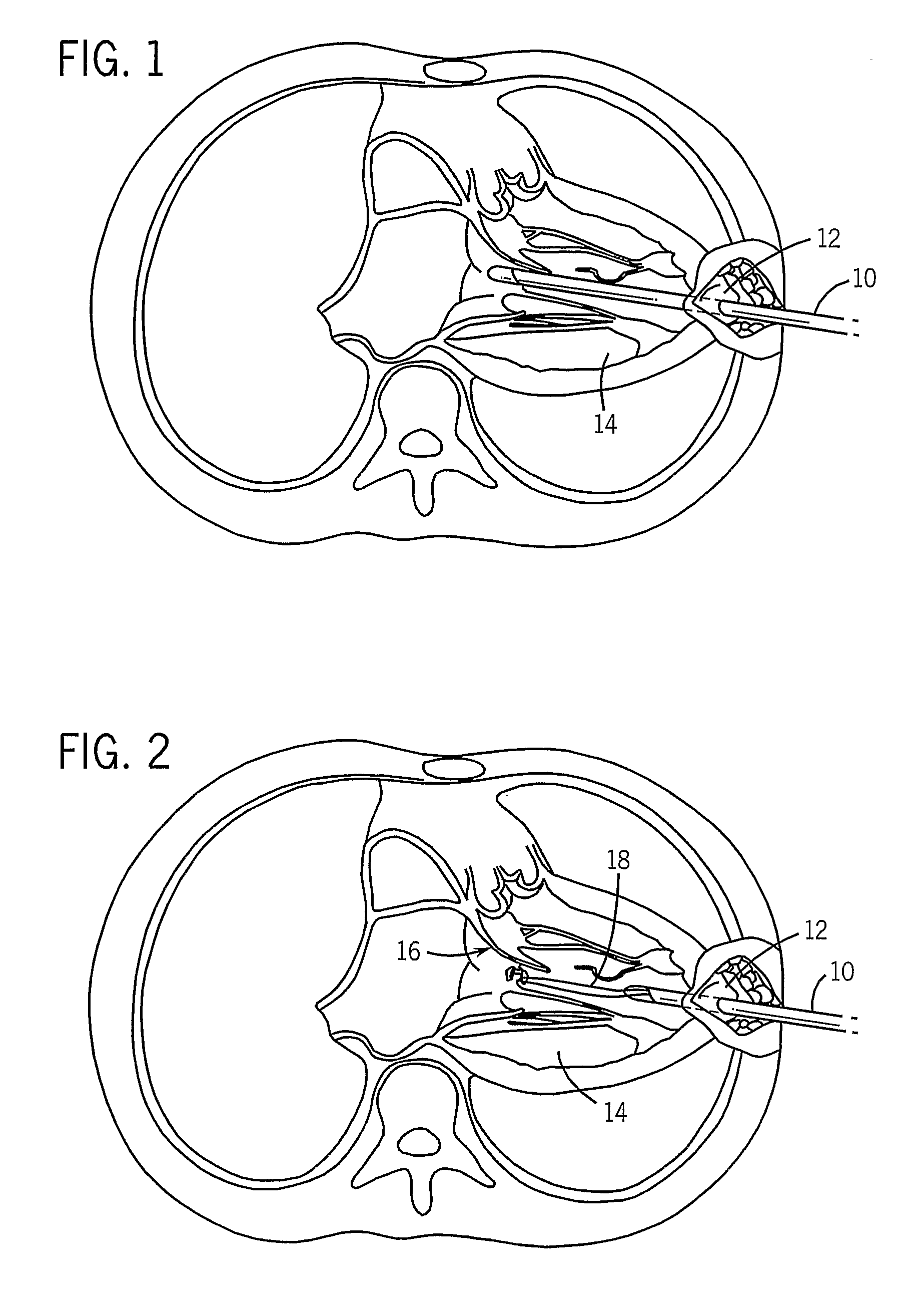 Thorascopic Heart Valve Repair Method and Apparatus