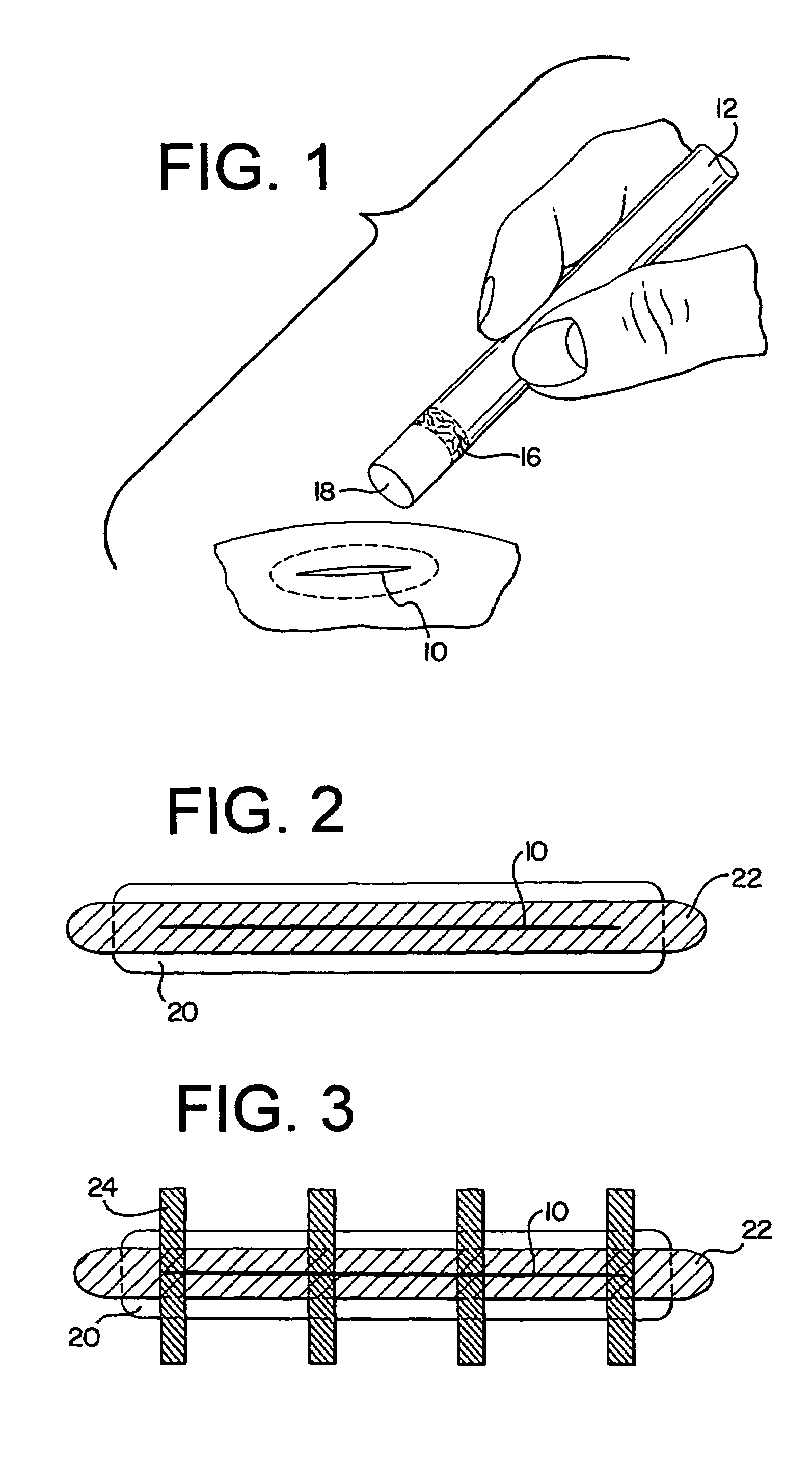 Dressing for treatment of short wounds located in high tension areas