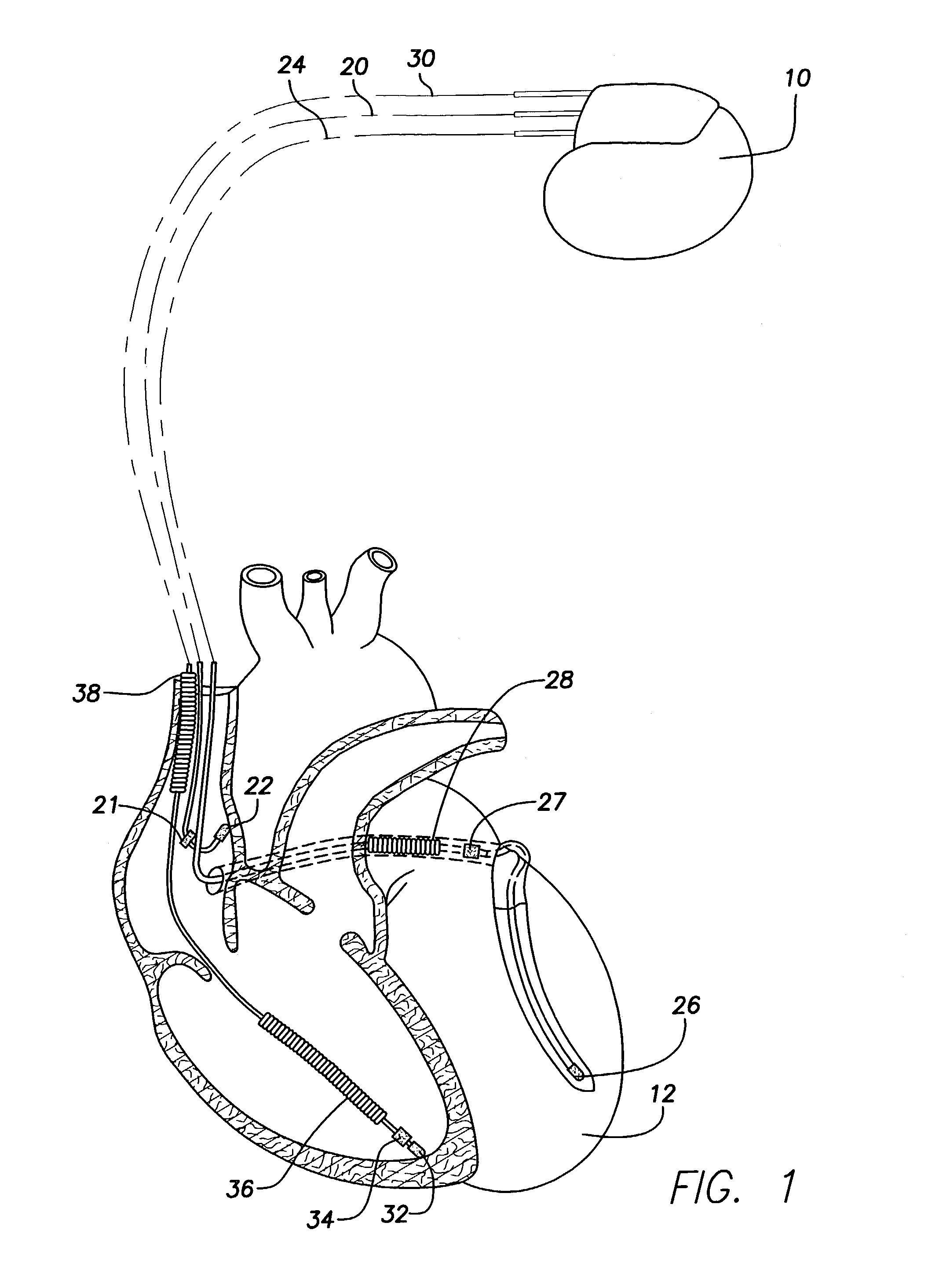 Implantable cardiac stimulation system providing autocapture and lead impedance assessment and method