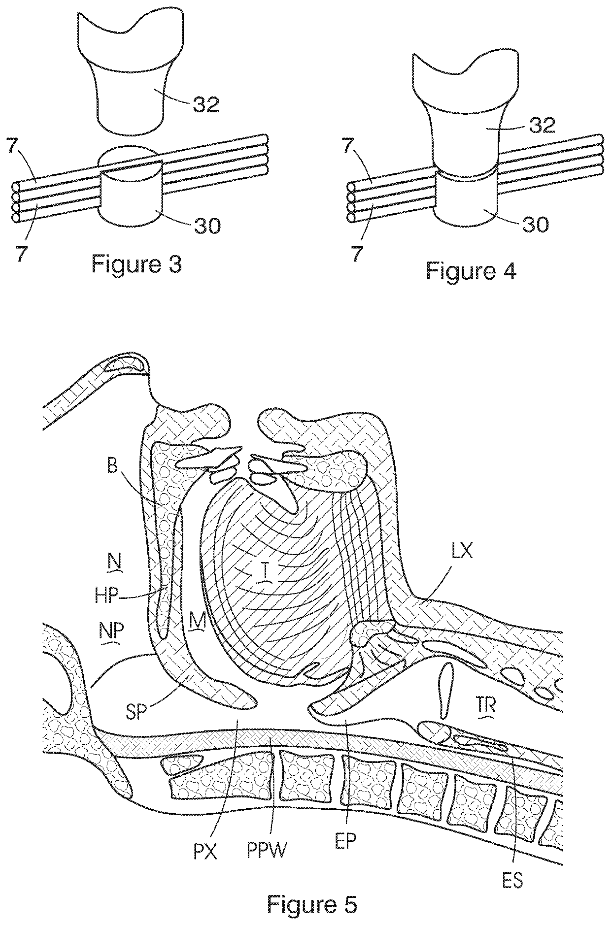 Implantable device