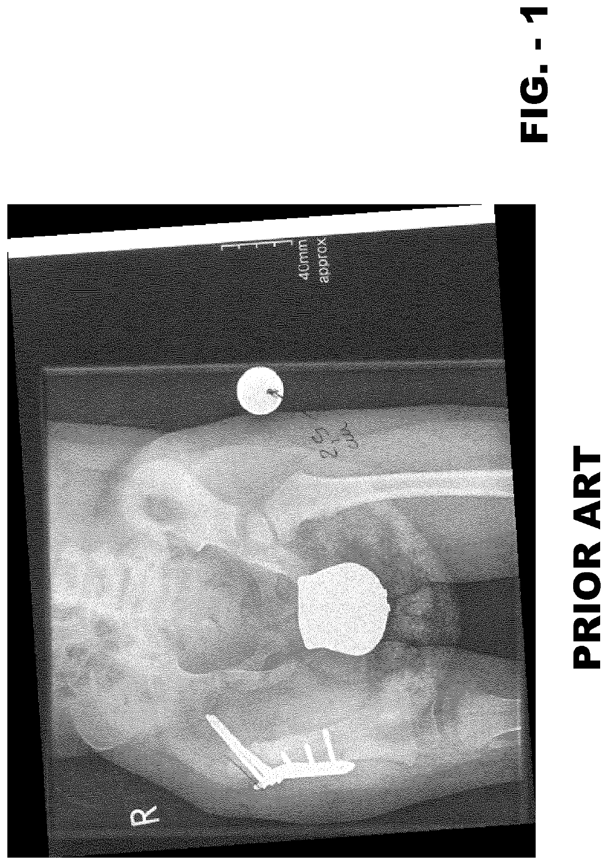 Internal fixation device for the pediatric correction of severe bone malformations