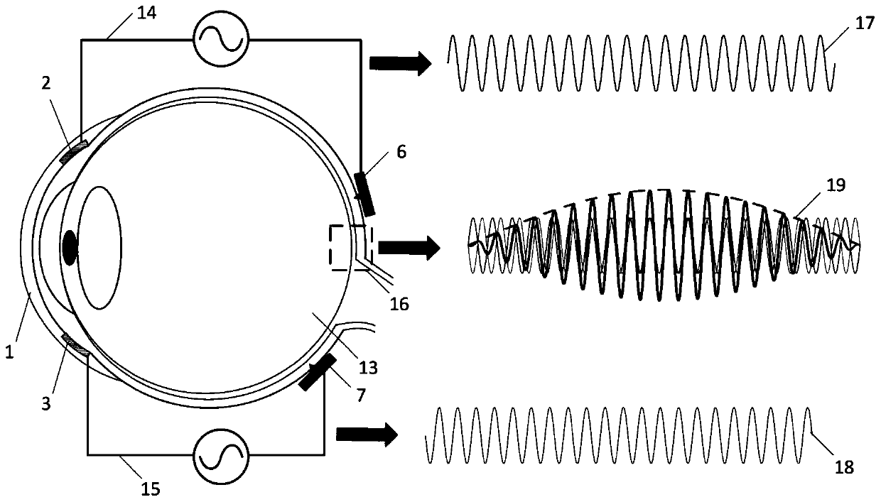 Extraocular electrode array equipment for local electric stimulation of retina