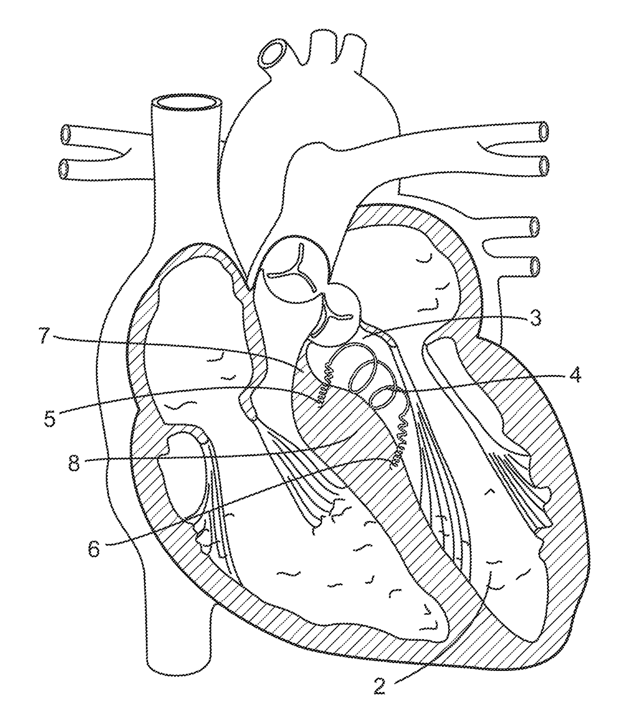 Implantable intracardiac device and methods thereof