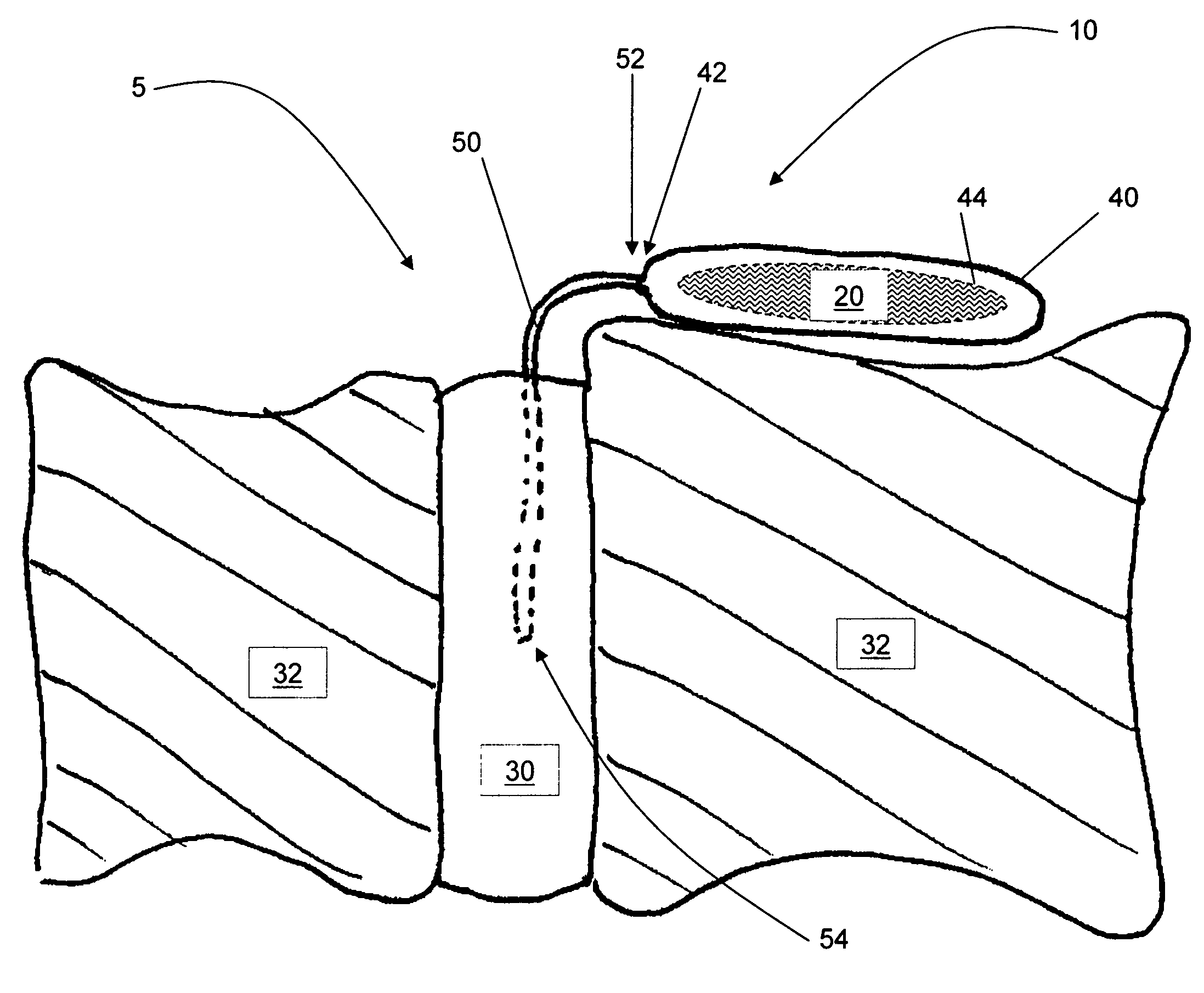 Release of BMP, bioactive agents and/or cells via a pump into a carrier matrix