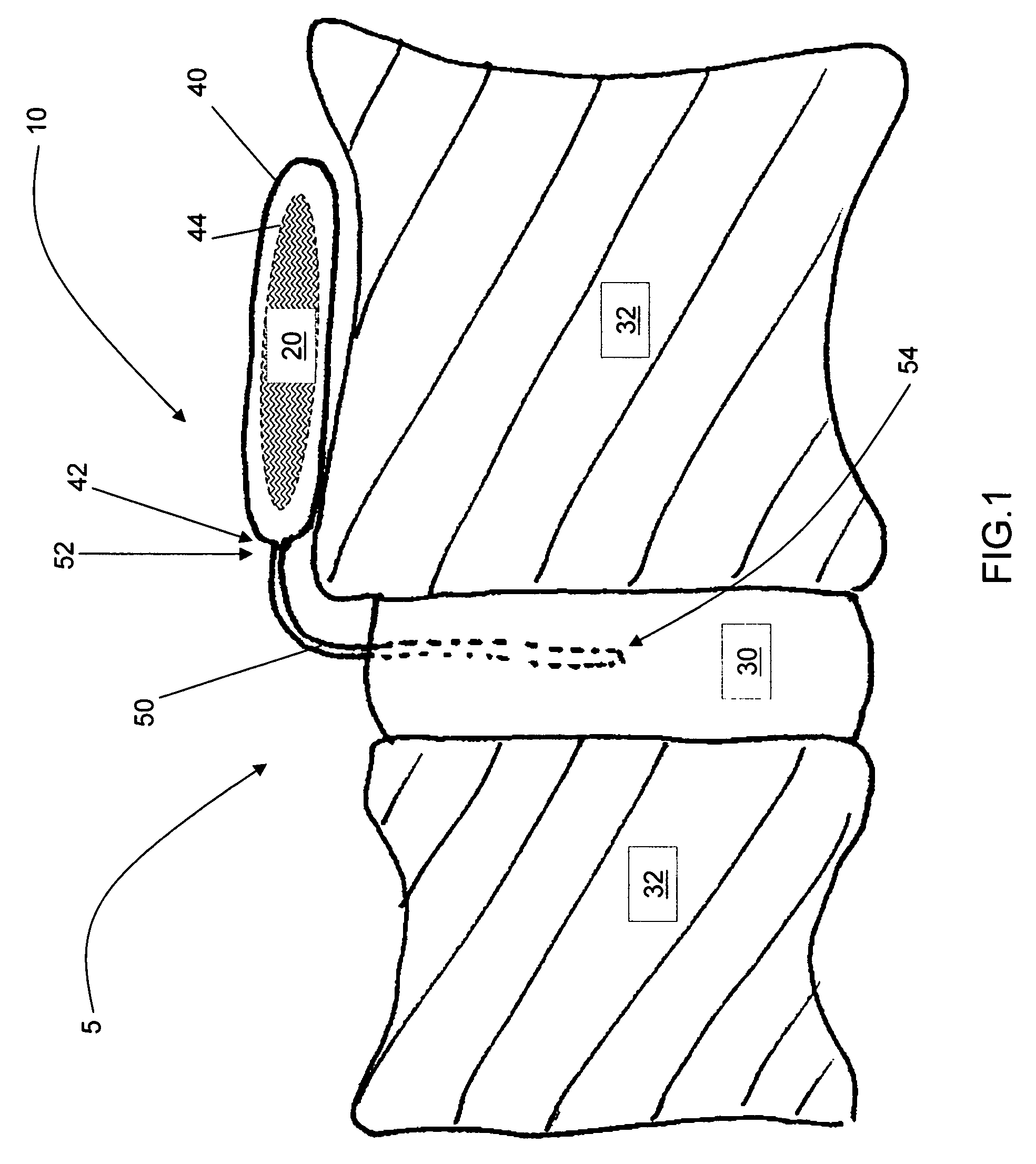 Release of BMP, bioactive agents and/or cells via a pump into a carrier matrix