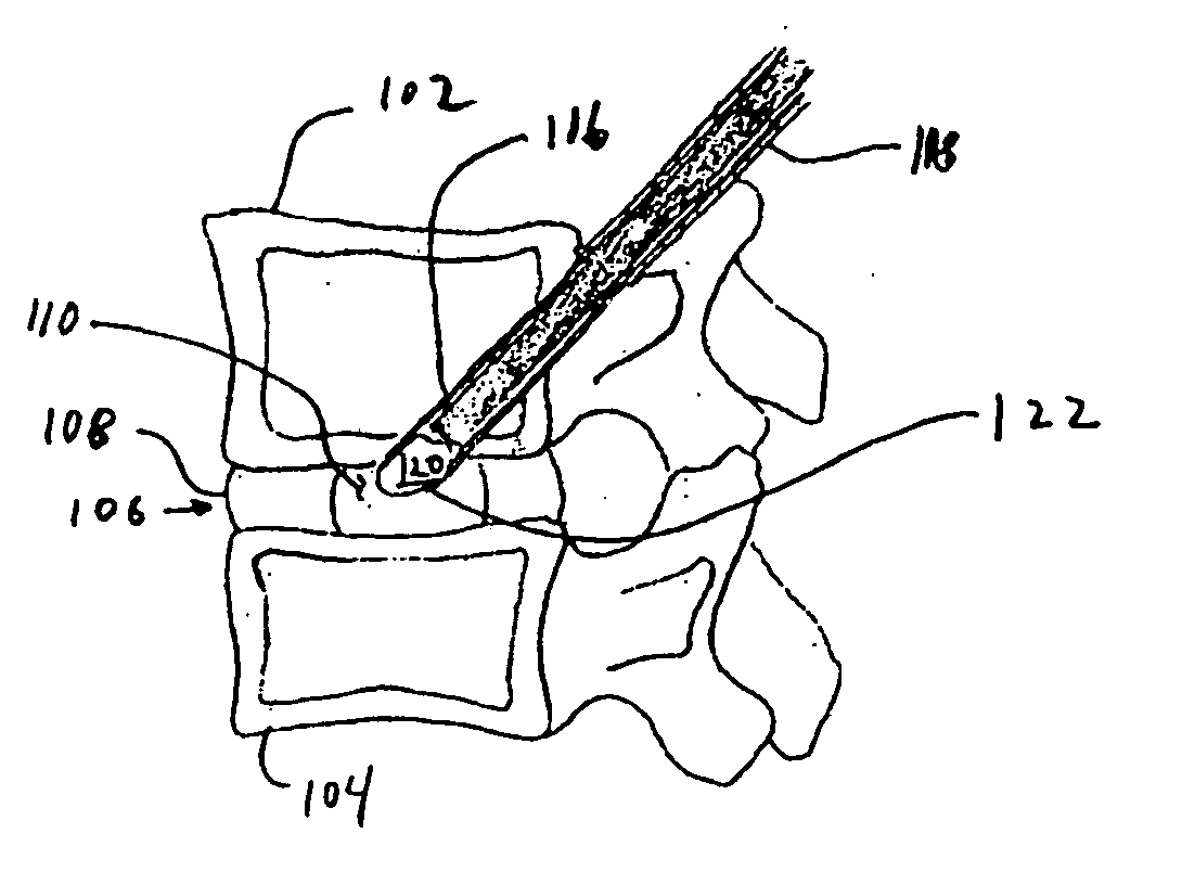 Supplementation or replacement of a nucleus pulposus of an intervertebral disc