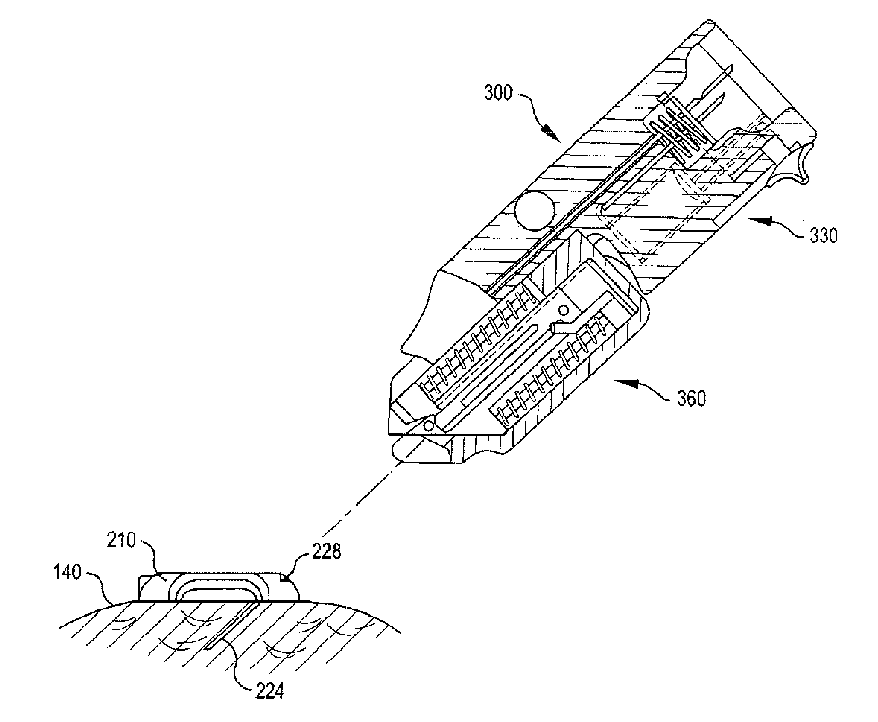 Disposable infusion device with locked cannula