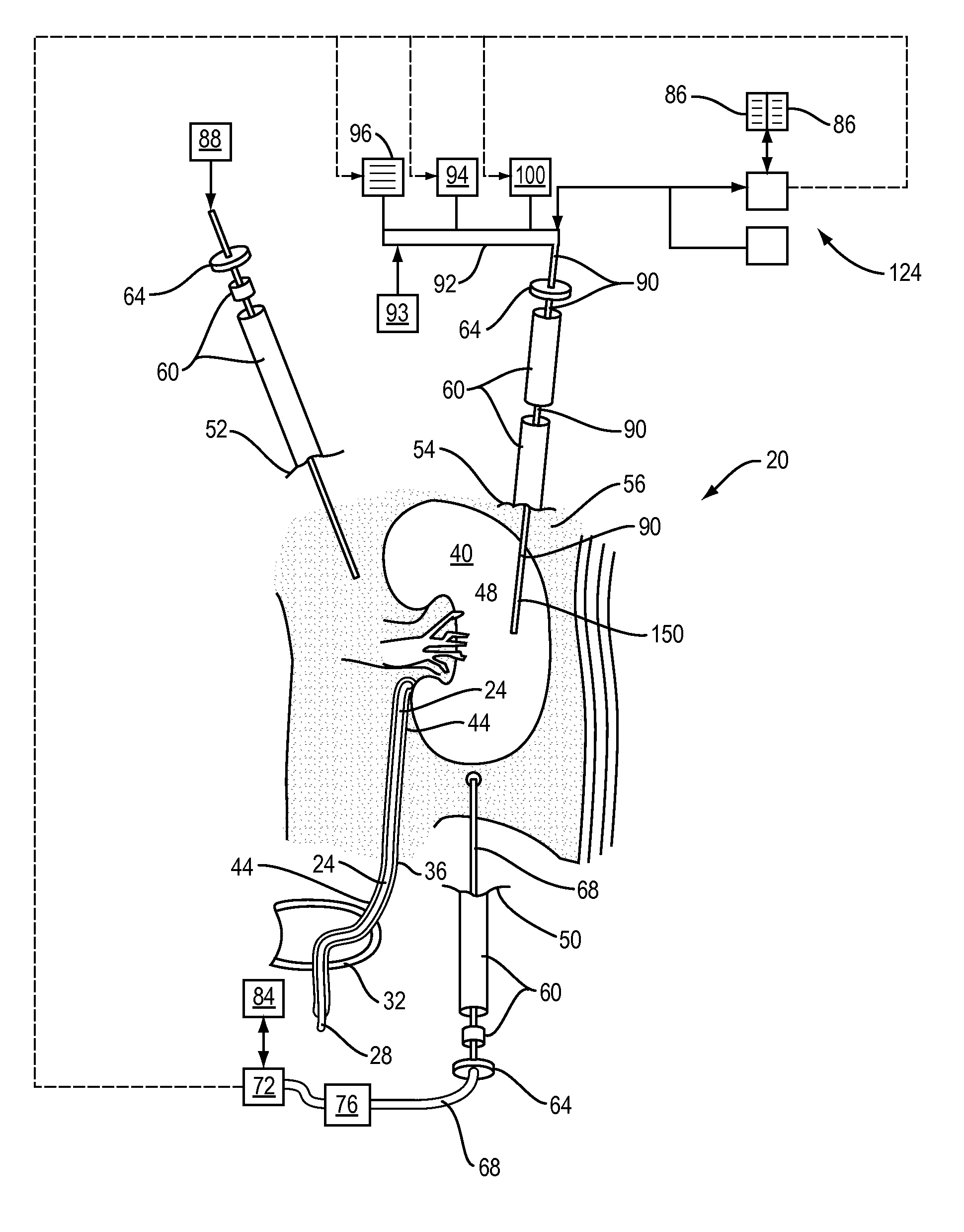 Laparoscopic hifu probe