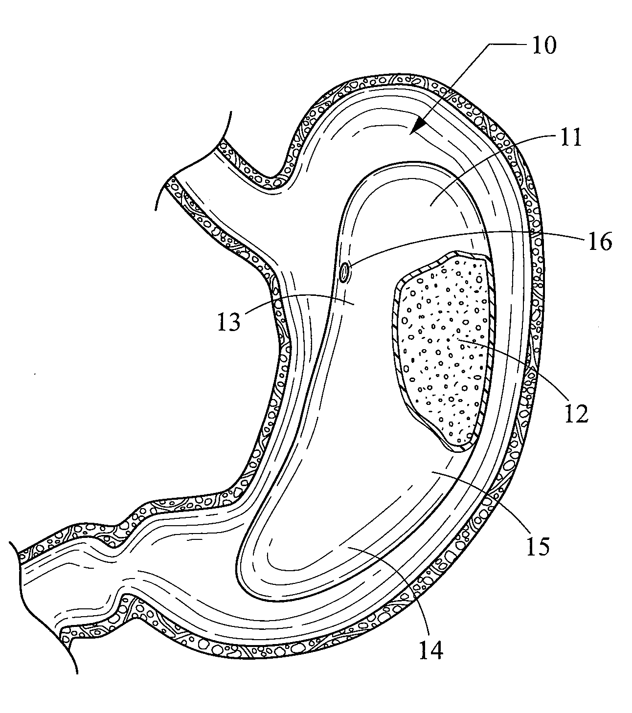 Foam filled intragastric balloon for treating obesity