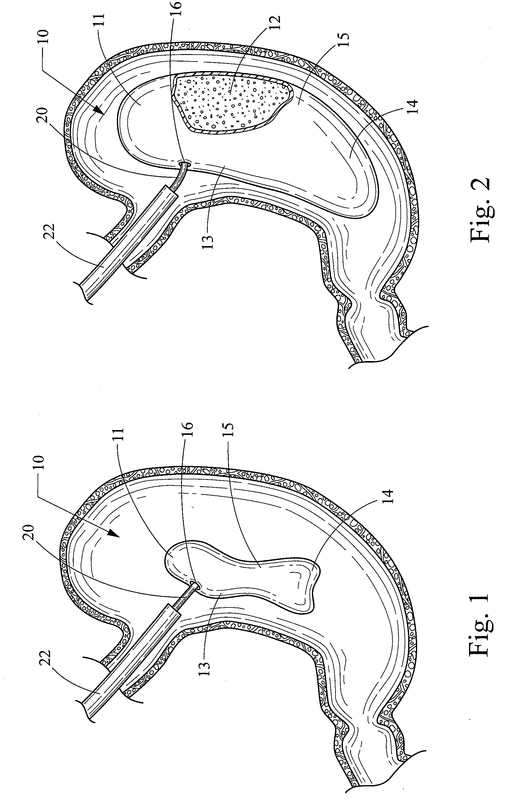 Foam filled intragastric balloon for treating obesity