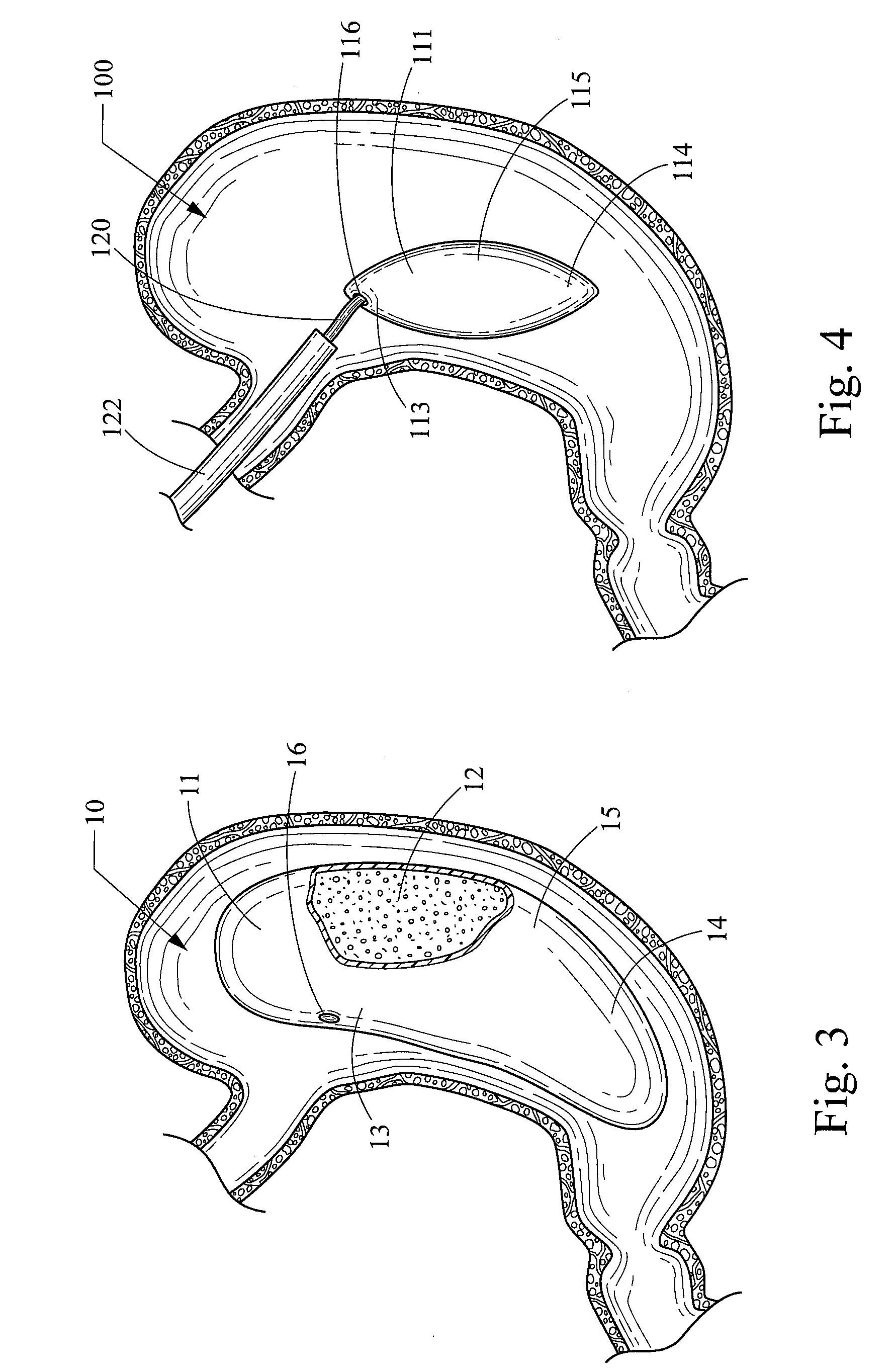 Foam filled intragastric balloon for treating obesity