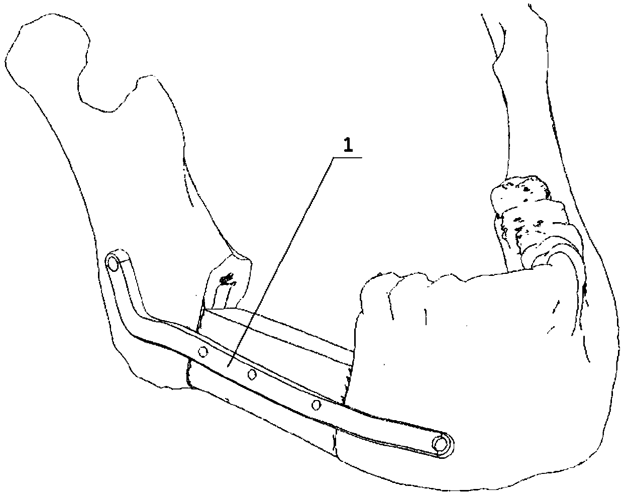 Synchronous implantation guide plate device