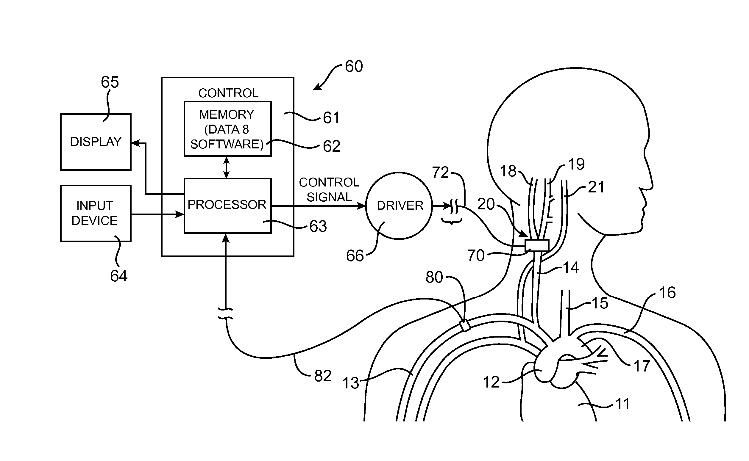 Baroreflex Therapy for Disordered Breathing