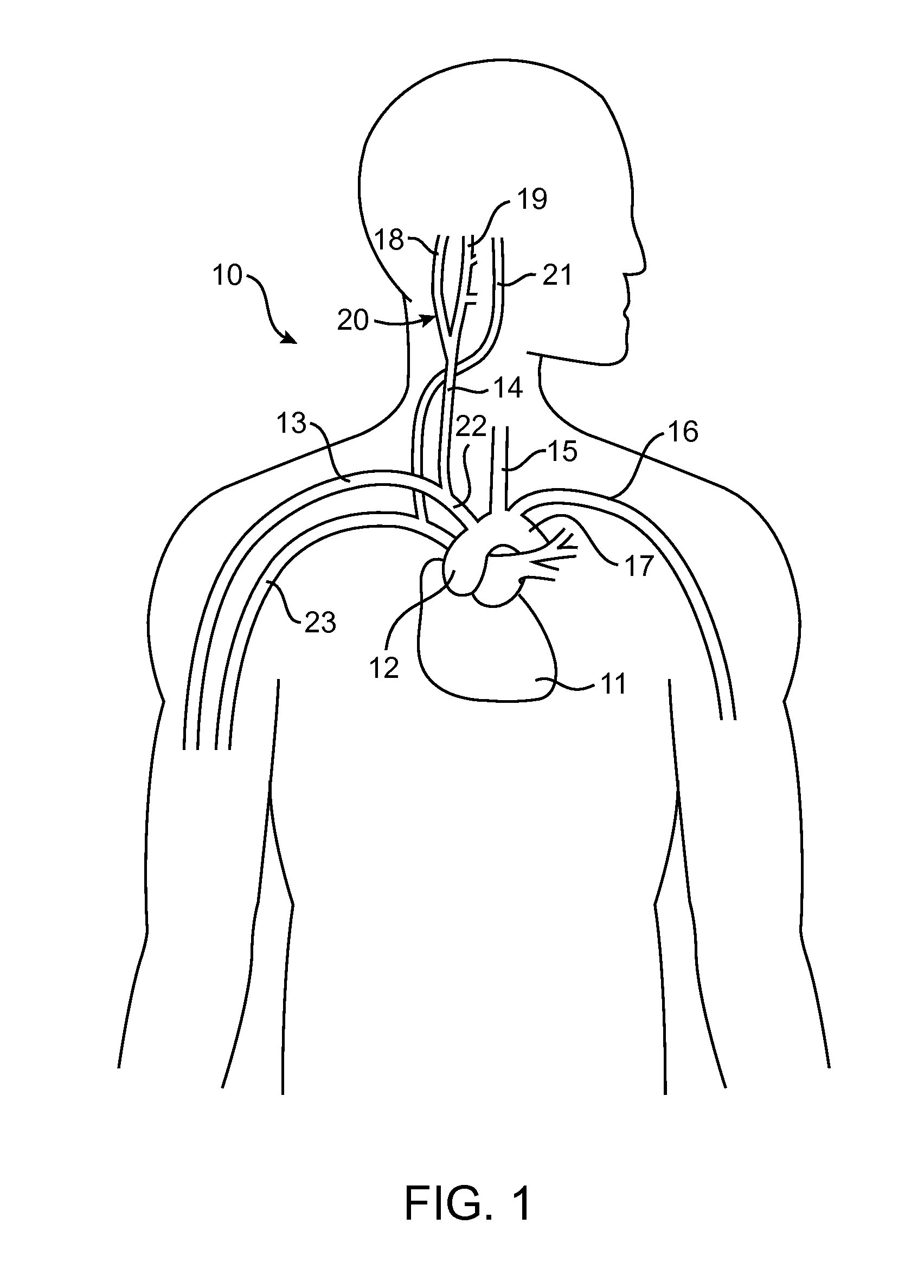 Baroreflex Therapy for Disordered Breathing