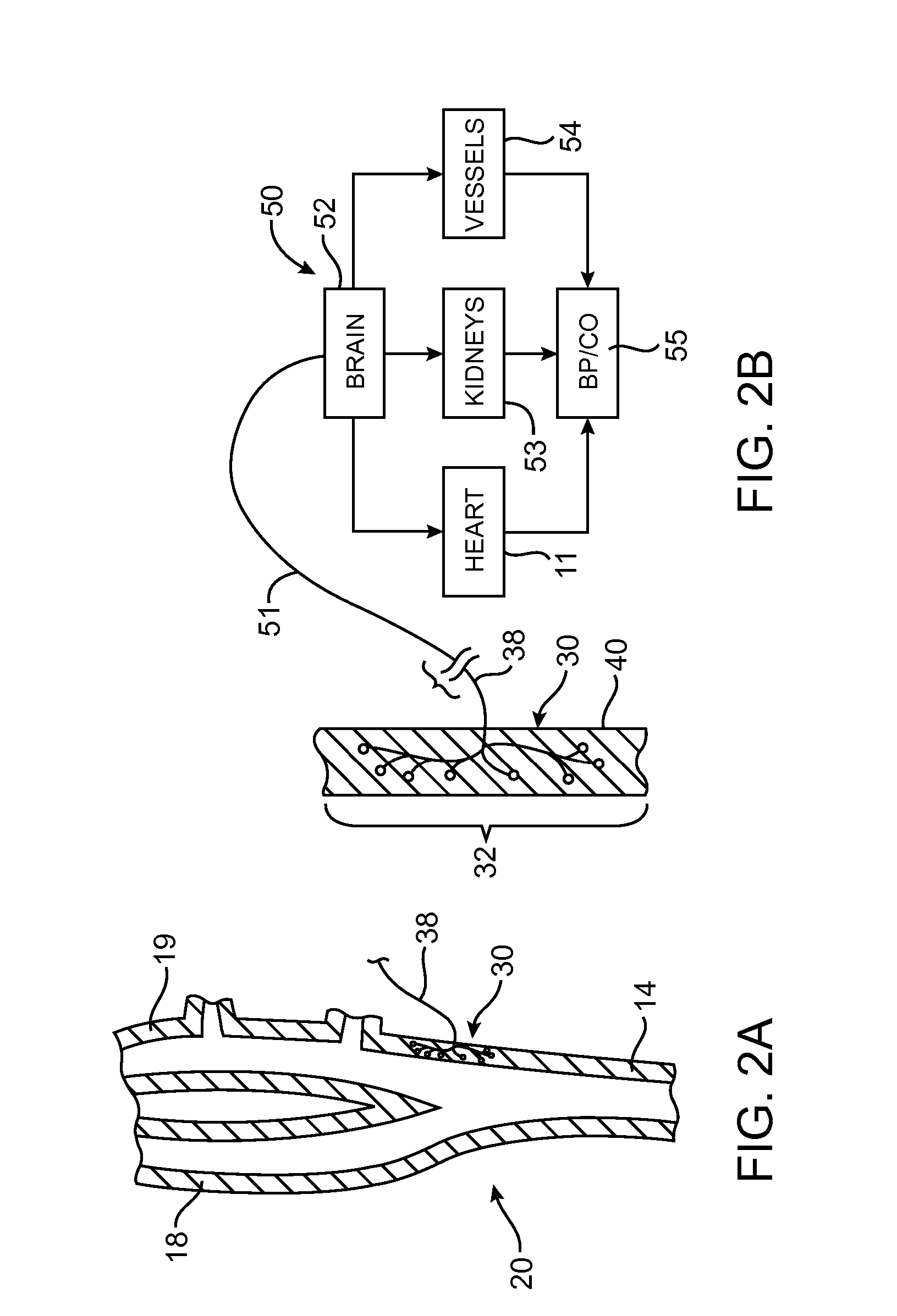 Baroreflex Therapy for Disordered Breathing