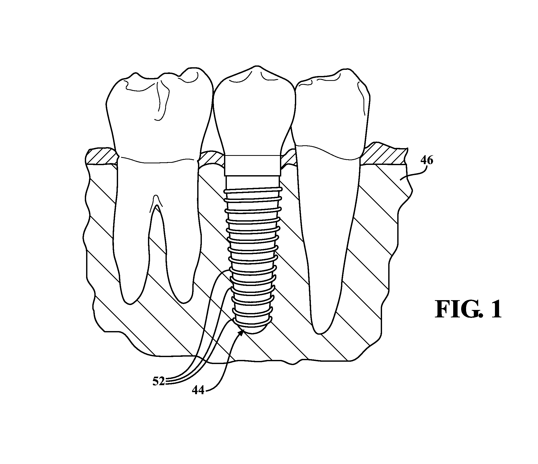 Fluted osteotome and surgical method for use