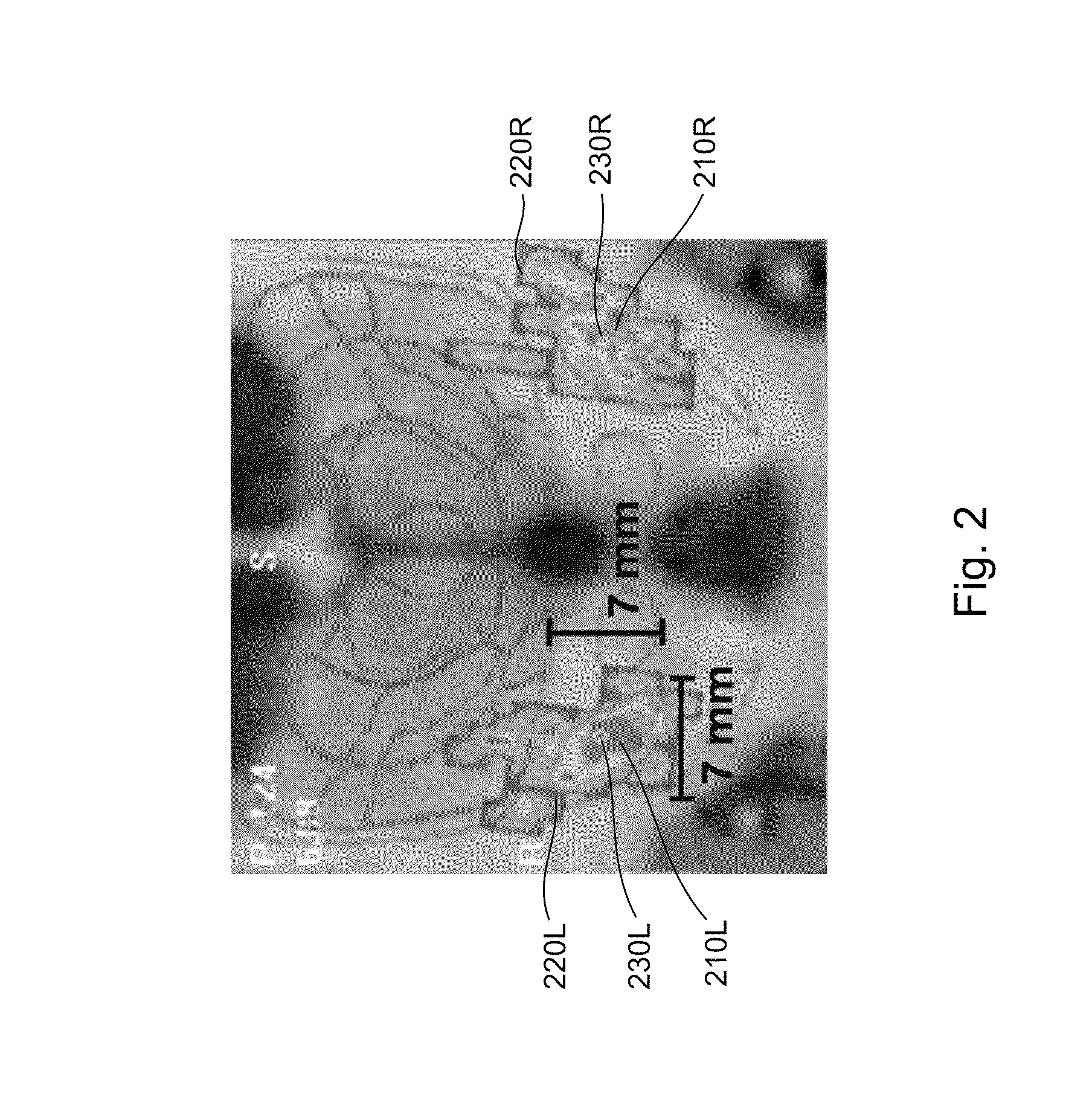 System and methods of deep brain stimulation for post-operation patients