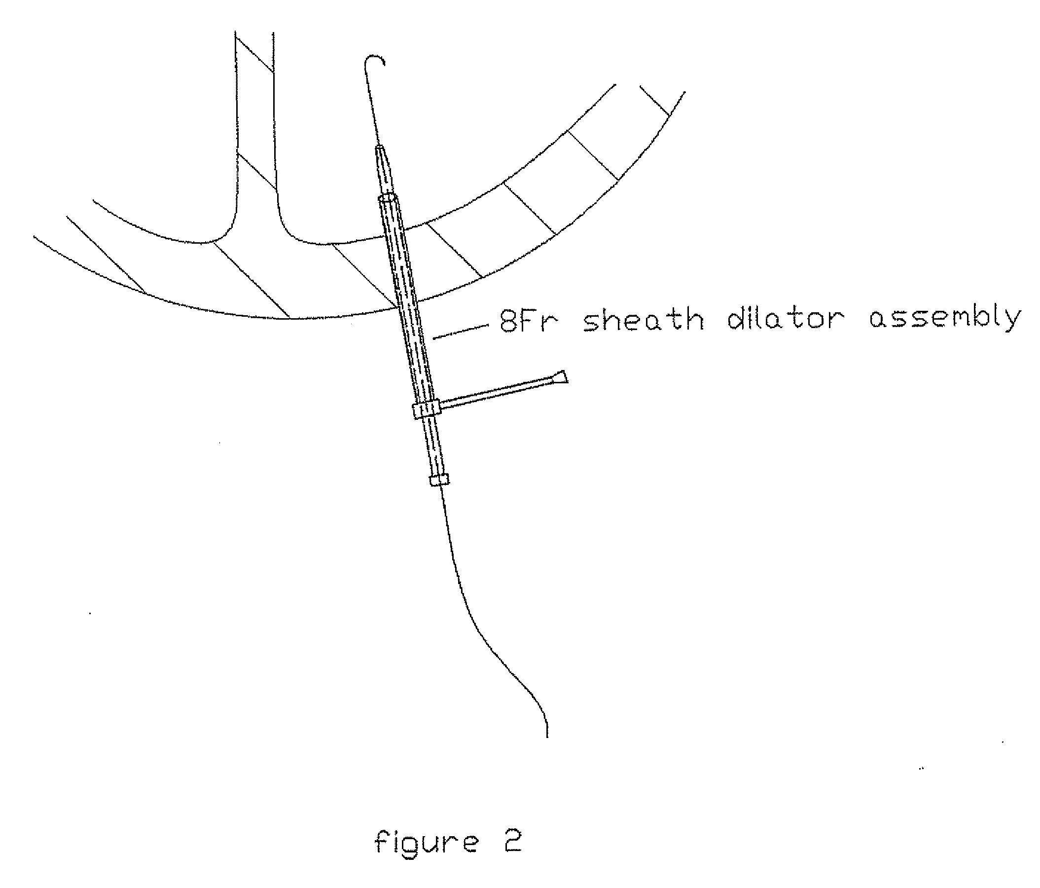 Cardiovascular procedures