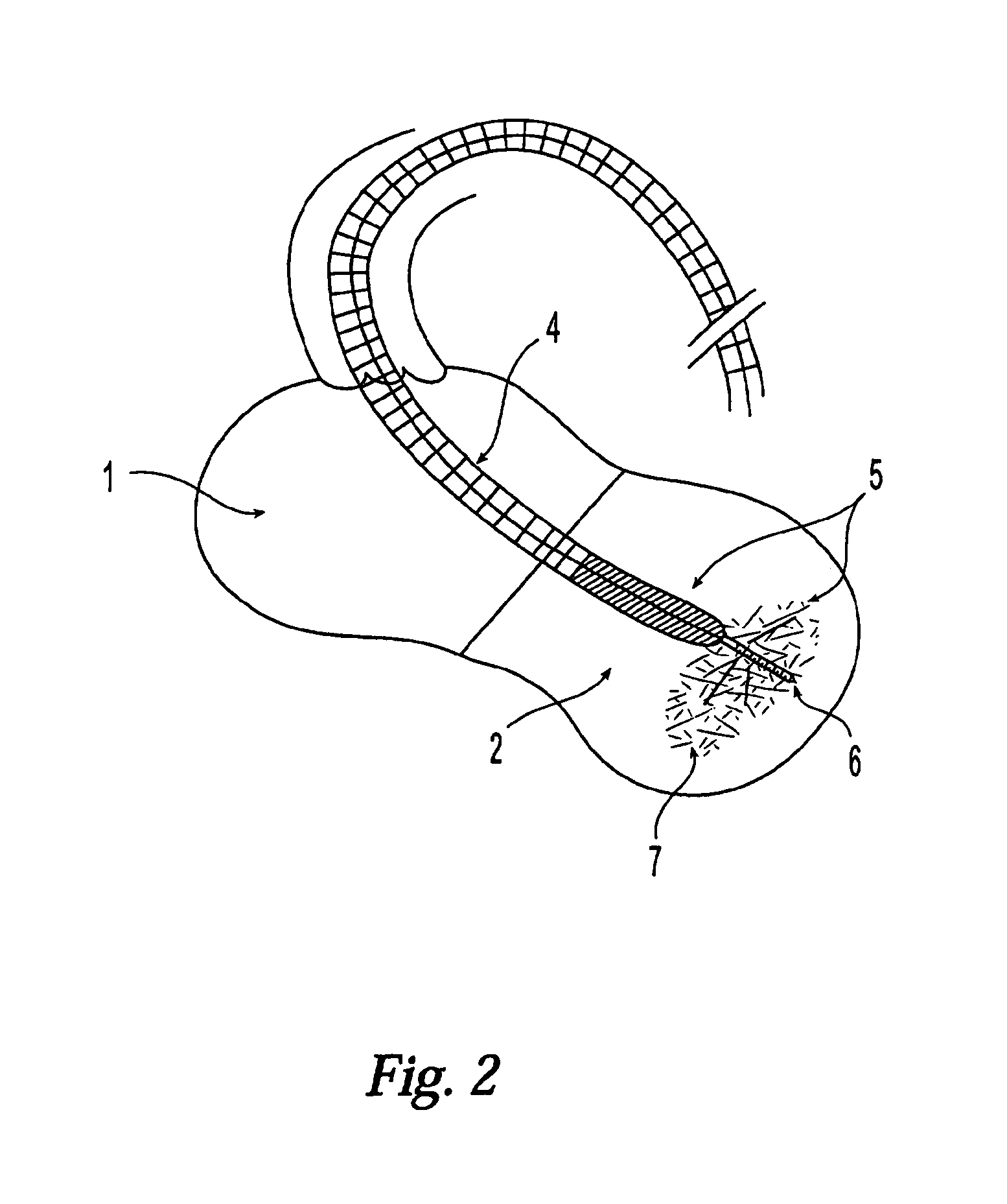 Modification of properties and geometry of heart tissue to influence function