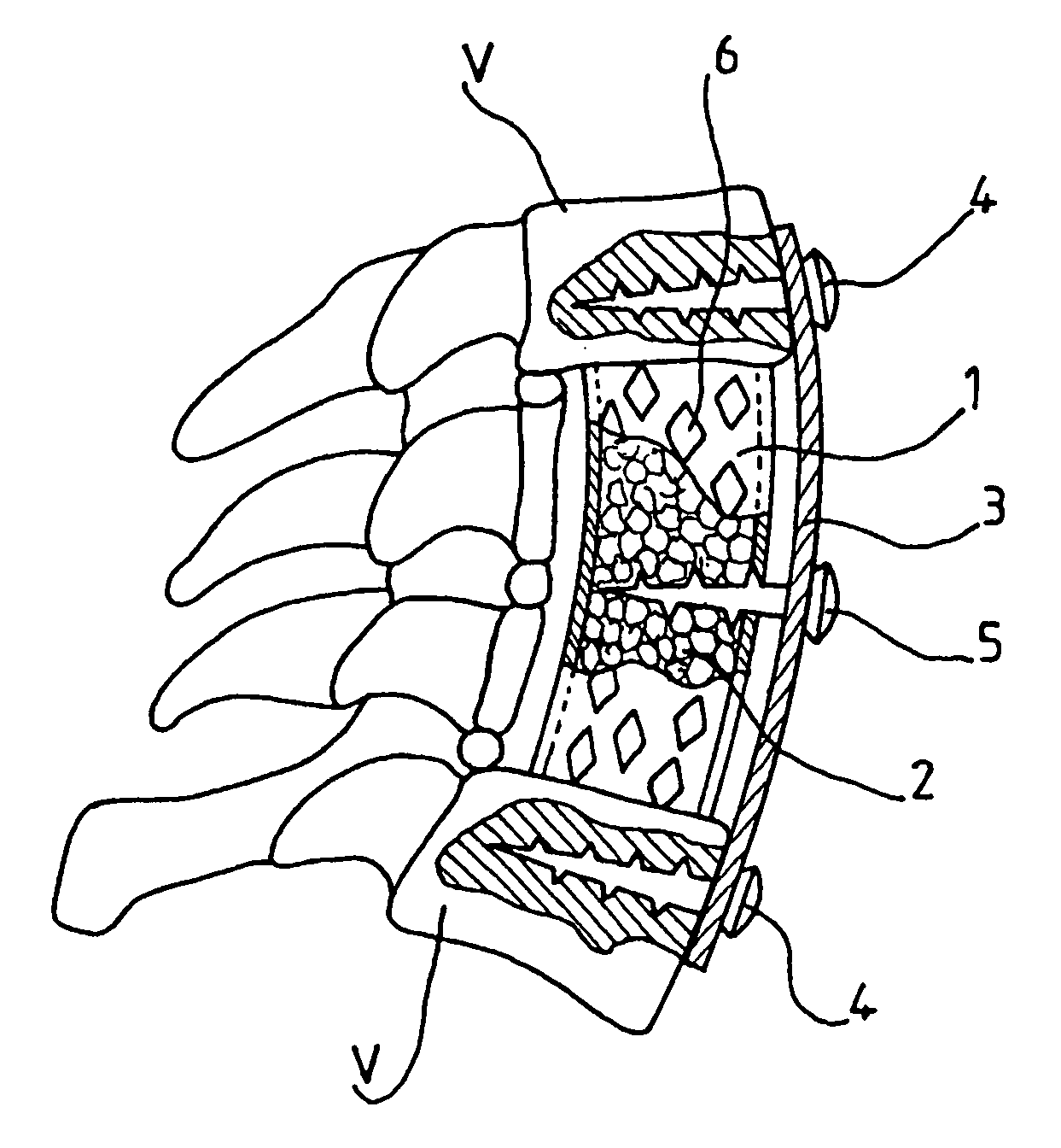 Bone repair device