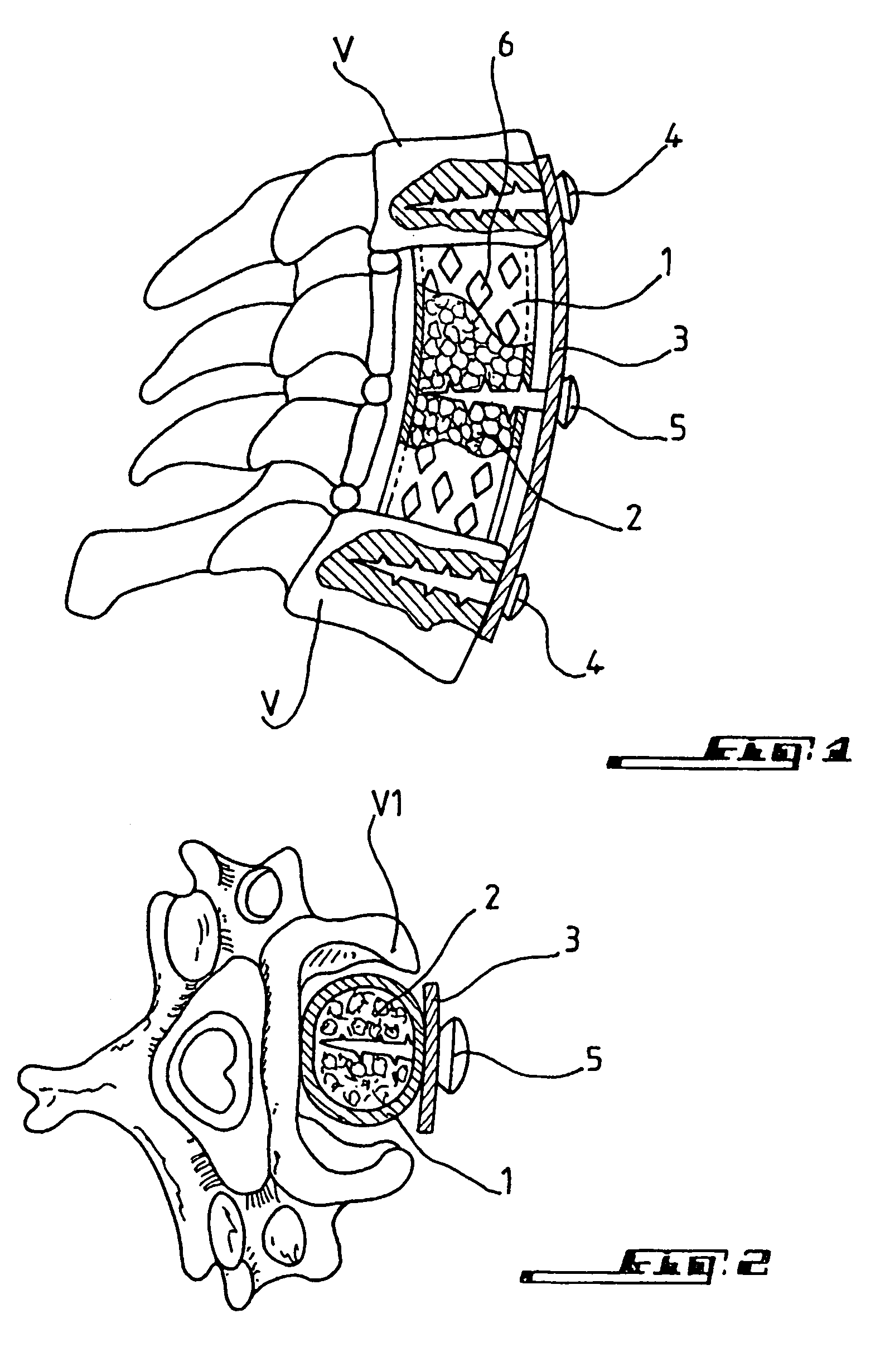 Bone repair device