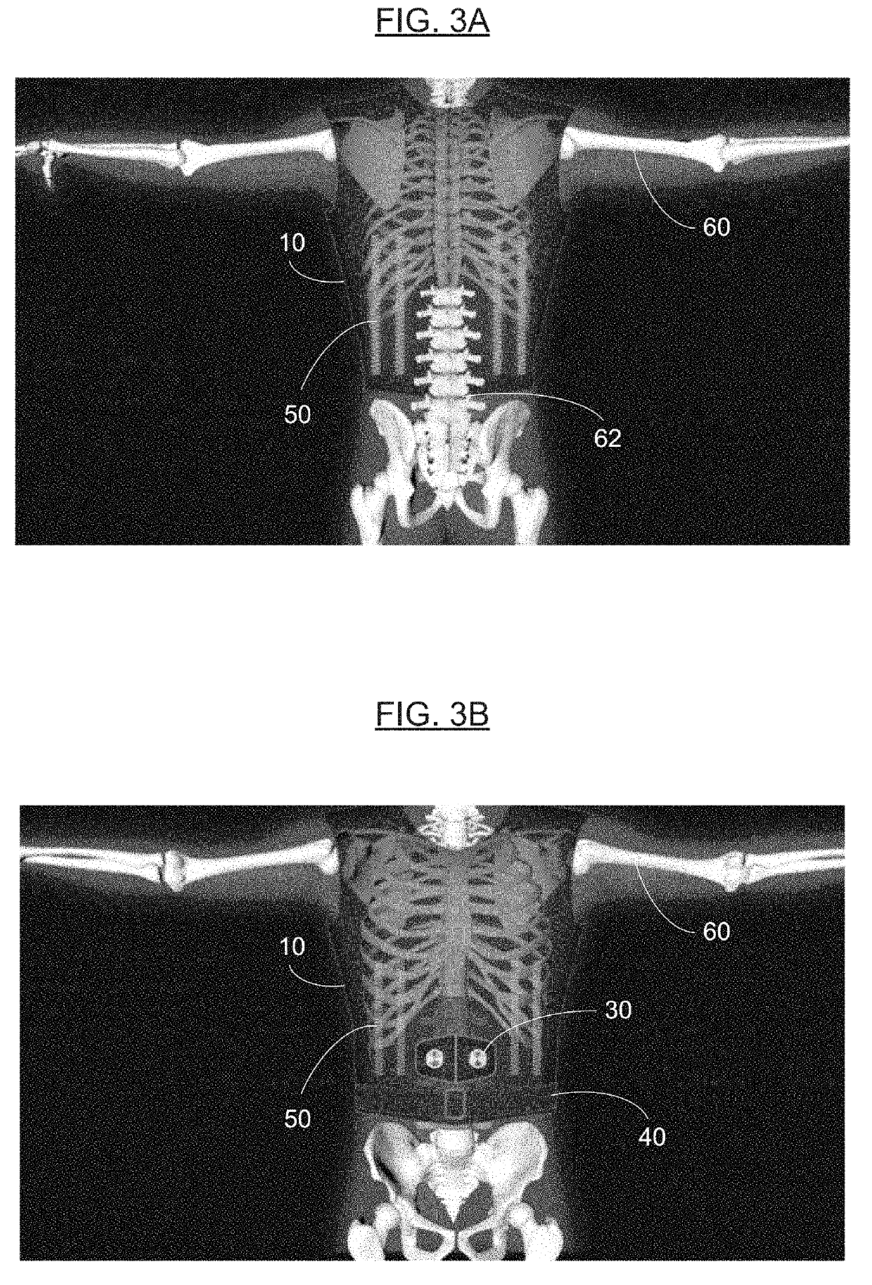 Braces for Alleviating Compression and Methods of Making and Using the Same