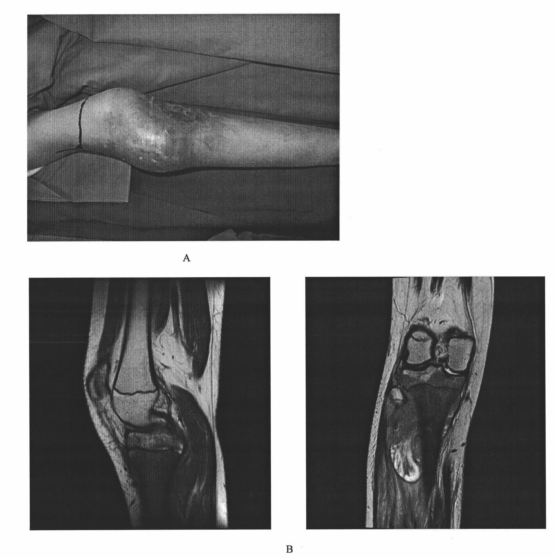 Human osteosarcoma cell line group and mouse in-vivo transplantation model