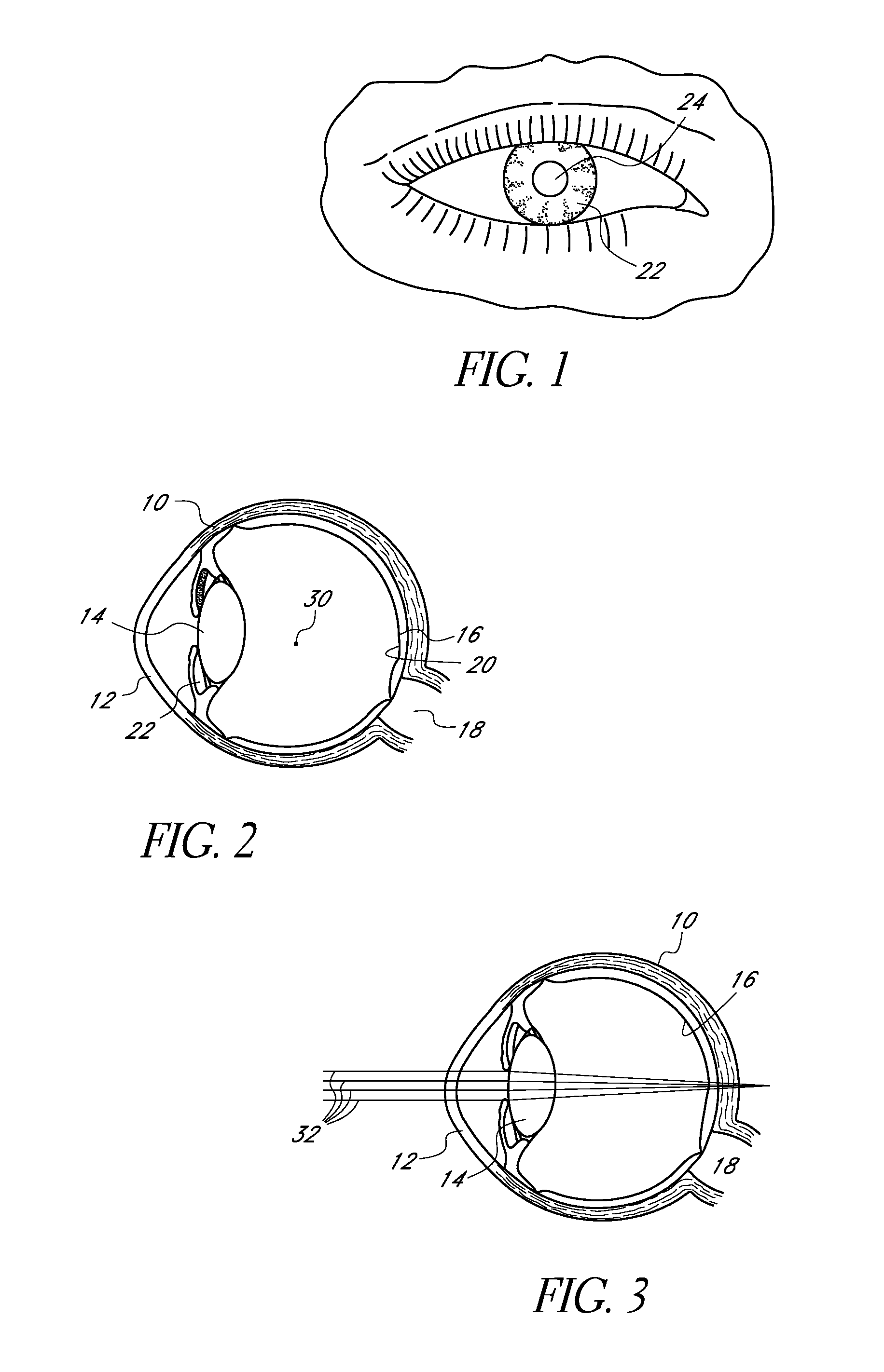 Corneal inlay with nutrient transport structures