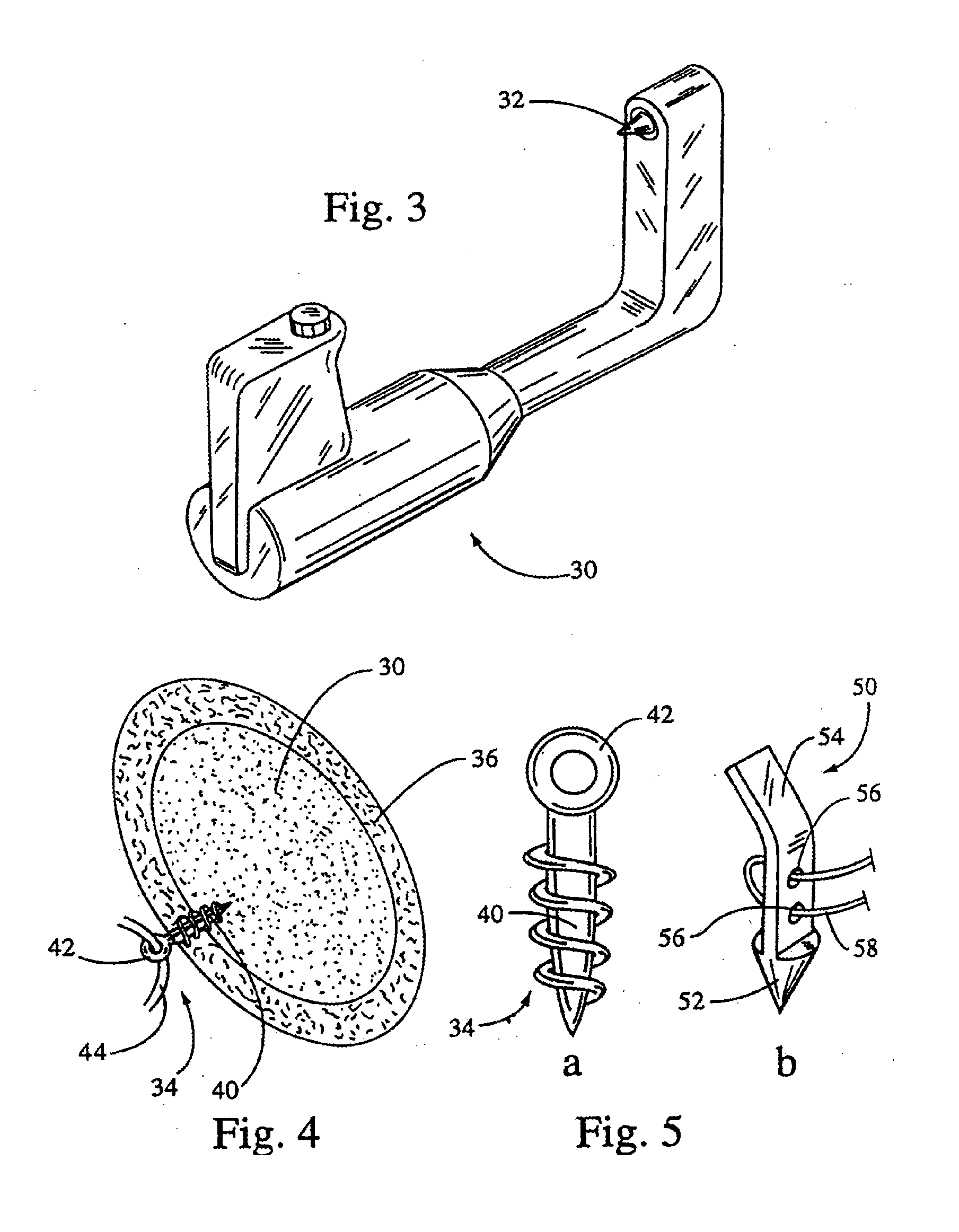 Method of Treating Vaginal Prolapse