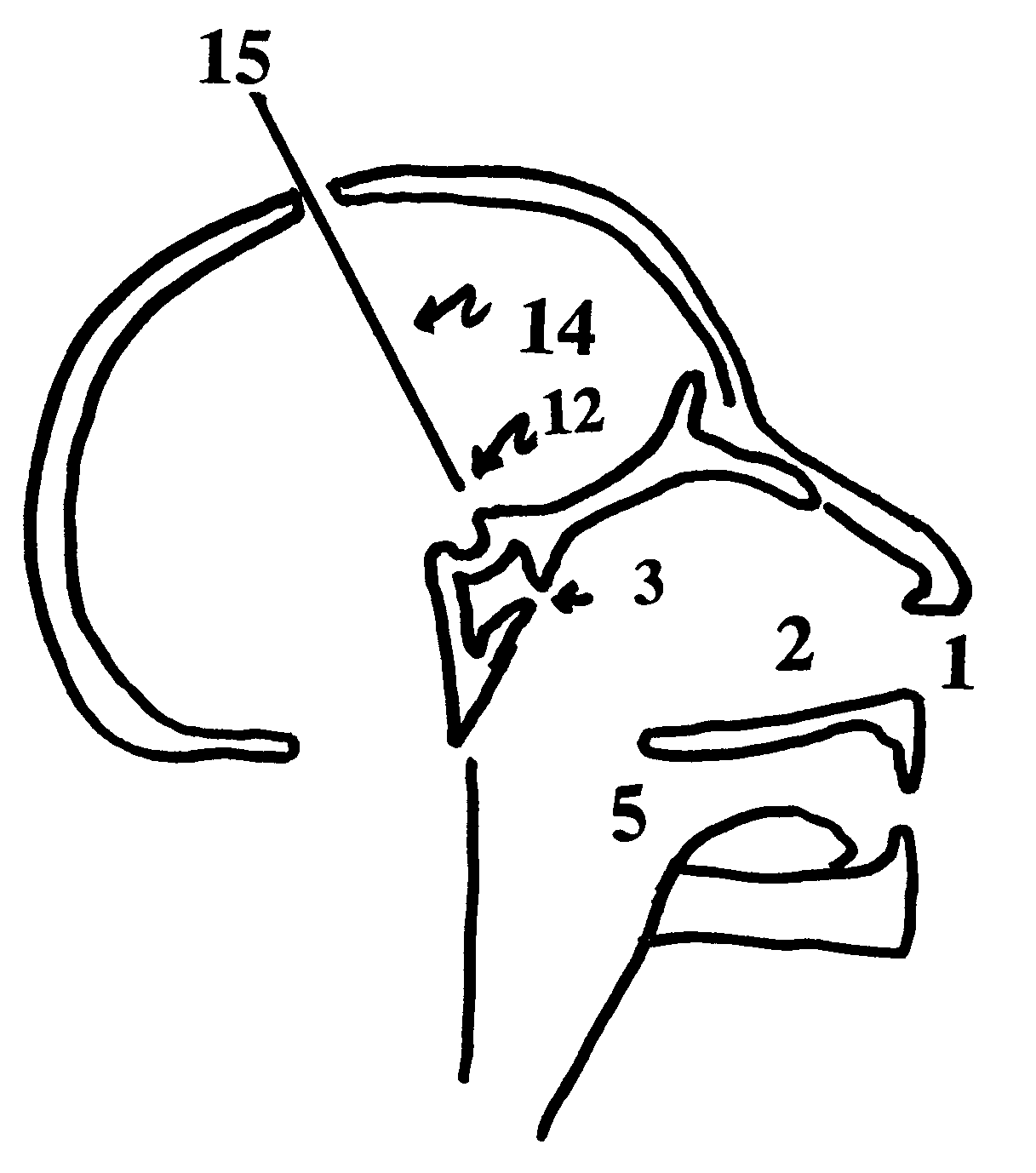 Method for inducing hypothermia for treating neurological disorders