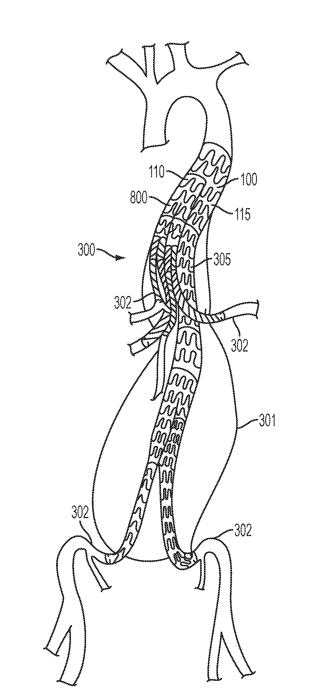 Combination Double-Barreled and Debranching Stent Grafts and Methods for Use