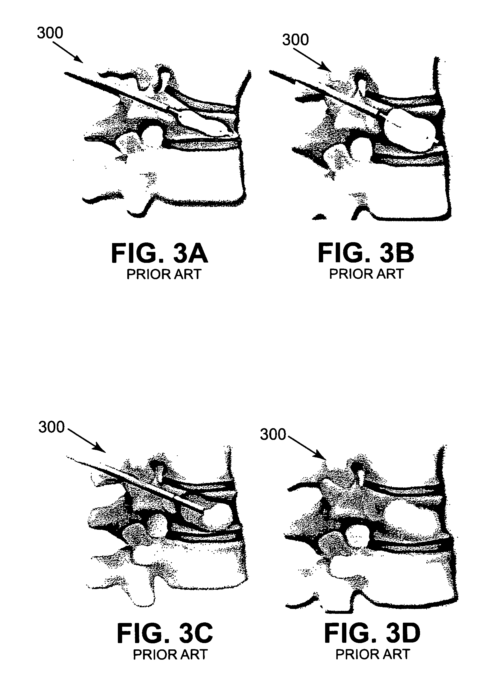 Apparatus and methods for vertebral augmentation