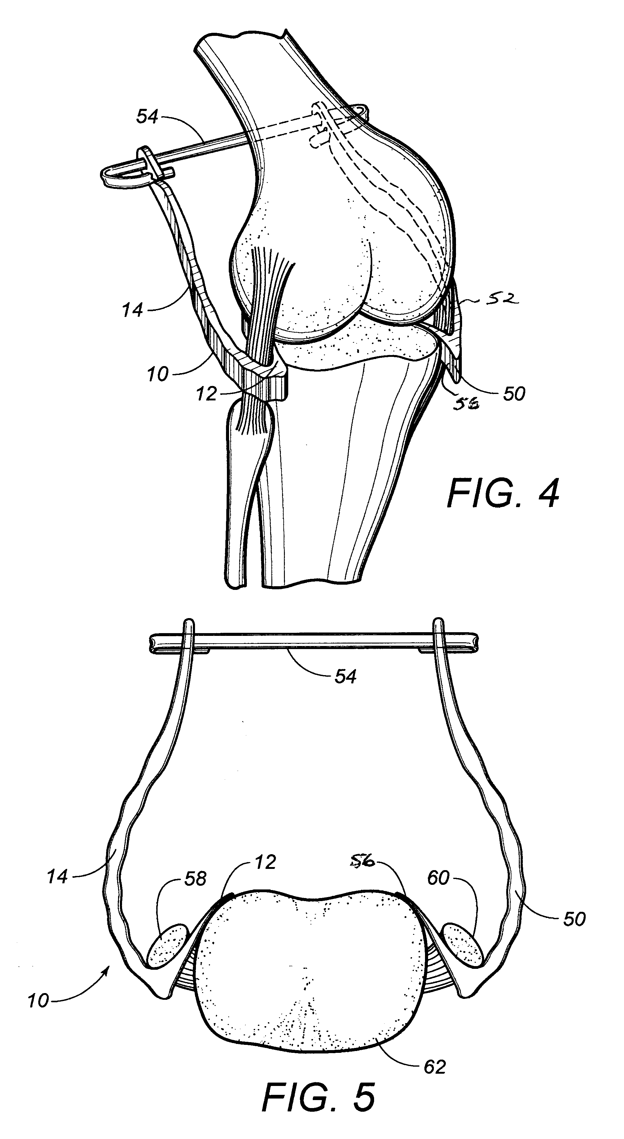 Ligament retractor assembly for use in performing knee surgery